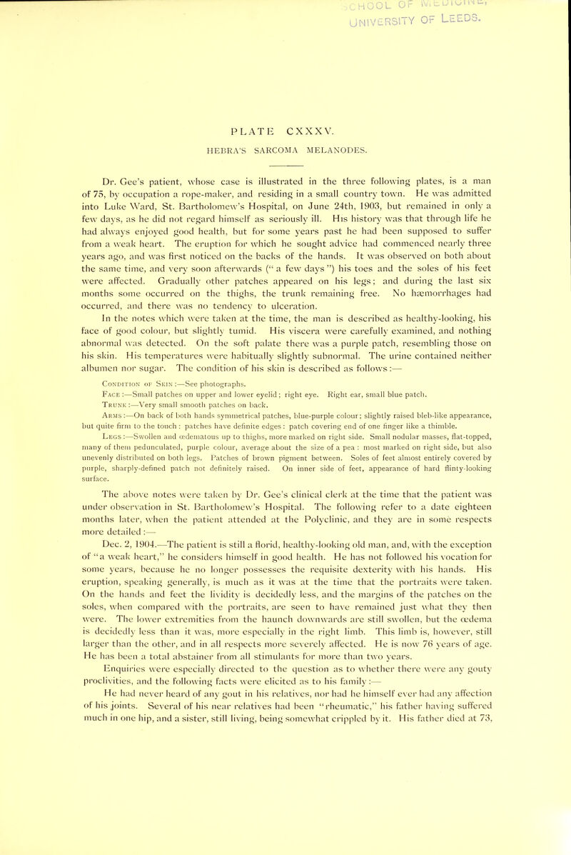 HEBRA’S SARCOMA MELANODES. Dr. Gee’s patient, whose case is illustrated in the three following plates, is a man of 75, by occupation a rope-maker, and residing in a small country town. He was admitted into Luke Ward, St. Bartholomew’s Hospital, on June 24th, 1903, but remained in only a few days, as he did not regard himself as seriously ill. His history was that through life he had always enjoyed good health, but for some years past he had been supposed to suffer from a weak heart. The eruption for which he sought advice had commenced nearly three years ago, and was first noticed on the backs of the hands. It was observed on both about the same time, and very soon afterwards (“ a few days ”) his toes and the soles of his feet were affected. Gradually other patches appeared on his legs; and during the last six months some occurred on the thighs, the trunk remaining free. No haemorrhages had occurred, and there was no tendency to ulceration. In the notes which were taken at the time, the man is described as healthy-looking, his face of good colour, but slightly tumid. His viscera were carefully examined, and nothing abnormal was detected. On the soft palate there was a purple patch, resembling those on his skin. His temperatures were habitually slightly subnormal. The urine contained neither albumen nor sugar. The condition of his skin is described as follows:— Condition of Skin :—See photographs. Face :—Small patches on upper and lower eyelid; right eye. Right ear, small blue patch. Trunk:—-Very small smooth patches on back. Arms On back of both hands symmetrical patches, blue-purple colour; slightly raised bleb-like appearance, but quite firm to the touch : patches have definite edges : patch covering end of one finger like a thimble. Legs :—Swollen and oedematous up to thighs, more marked on right side. Small nodular masses, fiat-topped, many of them pedunculated, purple colour, average about the size of a pea : most marked on right side, but also unevenly distributed on both legs. Patches of brown pigment between. Soles of feet almost entirely covered by purple, sharply-defined patch not definitely raised. On inner side of feet, appearance of hard flinty-looking surface. The above notes were taken by Dr. Gee’s clinical clerk at the time that the patient was under observation in St. Bartholomew’s Hospital. The following refer to a date eighteen months later, when the patient attended at the Polyclinic, and they are in some respects more detailed :— Dec. 2, 1904.—The patient is still a florid, healthy-looking old man, and, with the exception of “a weak heart,” he considers himself in good health. He has not followed his vocation for some years, because he no longer possesses the requisite dexterity with his hands. His eruption, speaking generally, is much as it was at the time that the portraits were taken. On the hands and feet the lividity is decidedly less, and the margins of the patches on the soles, when compared with the portraits, are seen to have remained just what they then were. The lower extremities from the haunch downwards are still swollen, but the oedema is decidedly less than it was, more especially in the right limb. This limb is, however, still larger than the other, and in all respects more severely affected. He is now 76 years of age. He has been a total abstainer from all stimulants for more than two years. Enquiries were especially directed to the question as to whether there were any gouty proclivities, and the following facts were elicited as to his family :— He had never heard of any gout in his relatives, nor had he himself ever had any affection of his joints. Several of his near relatives had been “rheumatic,” his father having suffered much in one hip, and a sister, still living, being somewhat crippled by it. His father died at 73,