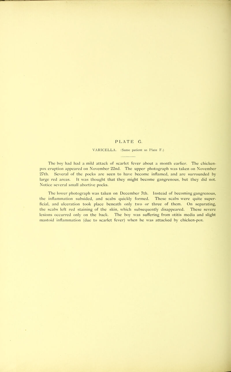 VARICELLA. (Same patient as Plate F.) The boy had had a mild attack of scarlet fever about a month earlier. The chicken- pox eruption appeared on November 22nd. The upper photograph was taken on November 27th. Several of the pocks are seen to have become inflamed, and are surrounded by large red areas. It was thought that they might become gangrenous, but they did not. Notice several small abortive pocks. The lower photograph was taken on December 7th. Instead of becoming gangrenous, the inflammation subsided, and scabs quickly formed. These scabs were quite super- ficial, and ulceration took place beneath only two or three of them. On separating, the scabs left red staining of the skin, which subsequently disappeared. These severe lesions occurred only on the back. The boy was suffering from otitis media and slight mastoid inflammation (due to scarlet fever) when he was attacked by chicken-pox.