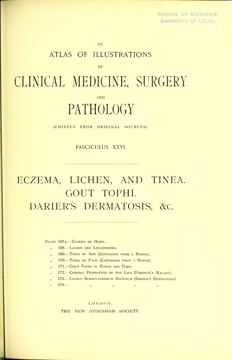 University of Leeds, AN ATLAS OF ILLUSTRATIONS OF CLINICAL MEDICINE, SURGERY ECZEMA, LICHEN, AND TINEA. GOUT TOPHI. DARTER’S DERMATOSIS, &c. Plate 167a.— Eczema of Hand. ,, 168.—Lichen and Leucoderma. ,, 169.—Tinea of Arm (Contagion from a Horse). ,, 170.—Tinea of Face (Contagion from a Horse). „ 171.—Gout Tophi in Hands and Ears. ,, 172.—Chronic Dermatitis of the Lips (Fordyce’s Malady). ,, 173.—Lichen Scrofulosorum Diutinum (Darier’s Dermatosis). AND (CHIEFLY FROM ORIGINAL SOURCES). FASCICULUS XXVI. 174. LONDON: THE NEW SYDENHAM SOCIETY.