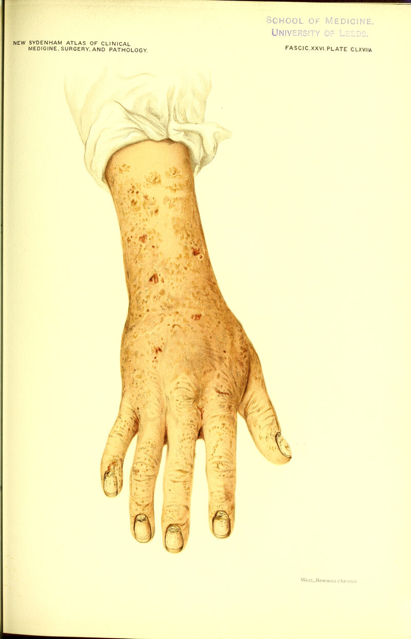 NEW SYDENHAM ATLAS OF CLINICAL MEDIGiNE, SURGERY, AND PATHOLOGY. oCHCOL OF MED\CINE, University of Leeds. FASCIC.XXVI.PLATE CLXVIIa t*. West .Newman chromo.