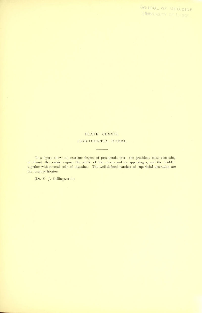 school of Medicine. University of ! PLATE CLXXIX. PROCIDENTIA UTERI. This figure shows an extreme degree of procidentia uteri, the procident mass consisting of almost the entire vagina, the whole of the uterus and its appendages, and the bladder, together with several coils of intestine. The well-defined patches of superficial ulceration are the result of friction. (Dr. C. J. Cullingworth.)