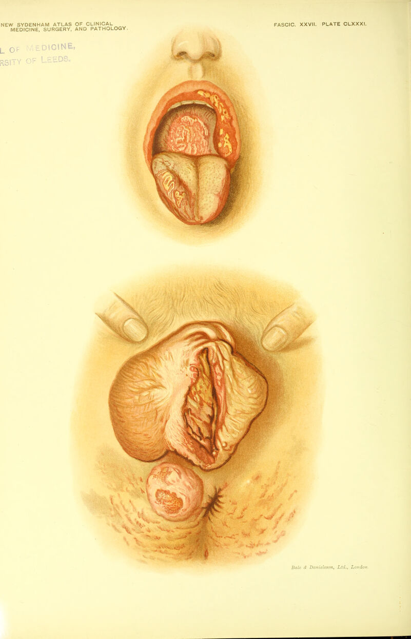 NEW SYDENHAM ATLAS OF CLINICAL FASCIC. XXVII. PLATE CLXXXI. MEDICINE, SURGERY, AND PATHOLOGY.