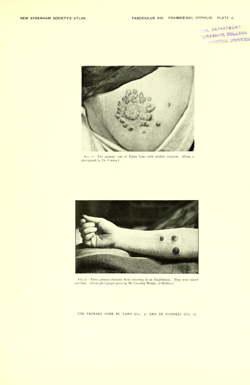 ,L (jgfABTWS* <• .^fcrtiKS ooi**® Fig. 2.—Three primary chancres from tattooing in an Englishman. They were raised and firm. (From photograph given by Mr. Crossley Wright, of Halifax.) T1IE PRIMARY SORE IN YAWS (Fig. i) AND IN SYPHILIS (Fig. 2).