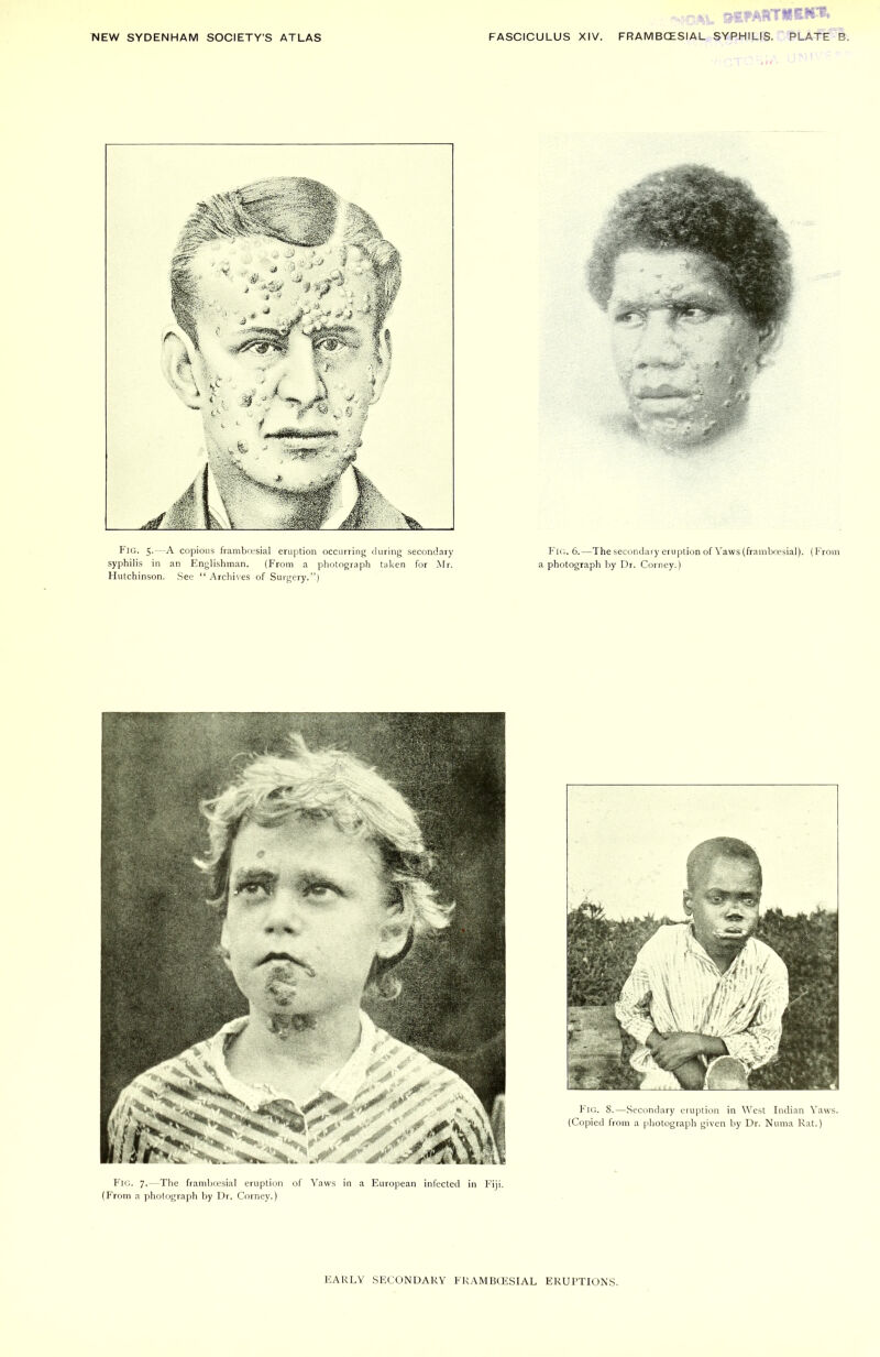 Fig. 5.—A copious frambcesial eruption occurring during secondary syphilis in an Englishman. (From a photograph taken for Mr. Hutchinson. See “Archives of Surgery.”) Fig. 6.—The secondary eruption of Yaws (framboesial). (From a photograph by Dr. Corney.) Fig. 7. -The frambcesial eruption of Yaws in a European infected in Fiji. (From a photograph by Dr. Corney.)