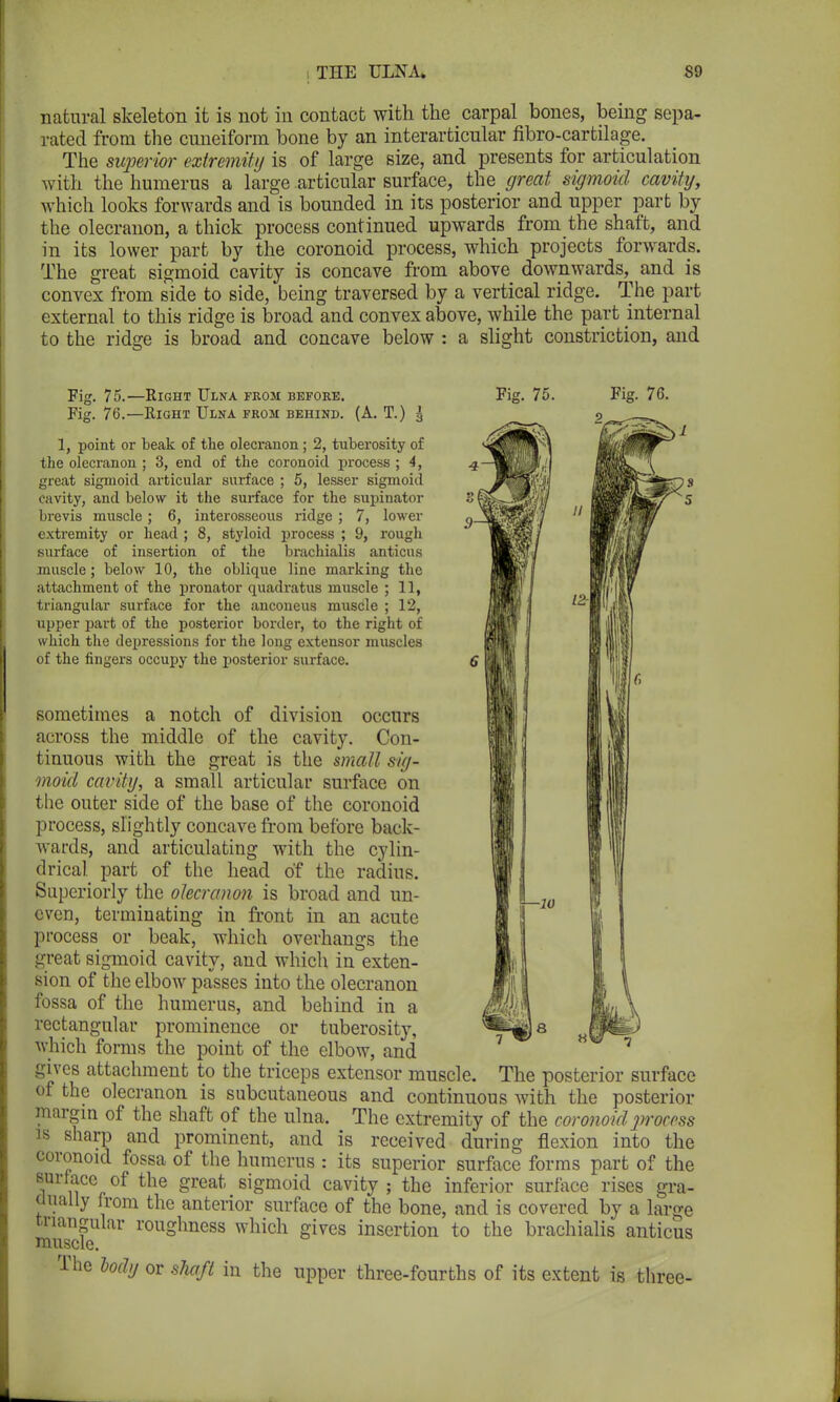 natural skeleton it is not in contact with the carpal bones, being sepa- rated from the cuneiform bone by an interarticular fibro-cartilage. The superior extremity is of large size, and presents for articulation with the humerus a large articular surface, the great sigmoid cavity, which looks forwards and is bounded in its posterior and upper part by the olecranon, a thick process continued upwards from the shaft, and in its lower part by the coronoid process, which projects forwards. The great sigmoid cavity is concave from above downwards, and is convex from side to side, being traversed by a vertical ridge. The part external to this ridge is broad and convex above, while the part internal to the ridge is broad and concave below : a slight constriction, and Fig. 75. Fig. 76. 2 Fig. 75.—Right Ulna from before. Fig. 76.—Right Ulna from behind. (A. T.) ^ 1, point or beak of the olecranon ; 2, tuberosity of the olecranon ; 3, end of the coronoid process ; 4, great sigmoid articular surface ; 5, lesser sigmoid cavity, and below it the surface for the supinator brevis muscle; 6, interosseous ridge ; 7, lower extremity or head ; 8, styloid process ; 9, rough surface of insertion of the brachialis anticus muscle; below 10, the oblique line marking the attachment of the pronator quadratus muscle ; 11, triangular surface for the anconeus muscle ; 12, upper part of the posterior border, to the right of which the depressions for the long extensor muscles of the fingers occupy the posterior surface. sometimes a notch of division occurs across the middle of the cavity. Con- tinuous with the great is the small sig- moid cavity, a small articular surface on the outer side of the base of the coronoid process, slightly concave from before back- wards, and articulating with the cylin- drical, part of the head of the radius. Superiorly the olecranon is broad and un- even, terminating in front in an acute process or beak, which overhangs the great sigmoid cavity, and which in exten- sion of the elbow passes into the olecranon fossa of the humerus, and behind in a rectangular prominence or tuberosity, which forms the point of the elbow, and gives attachment to the triceps extensor muscle. The posterior surface of the olecranon is subcutaneous and continuous with the posterior margin of the shaft of the ulna. The extremity of the coronoid process is sharp and prominent, and is received during flexion into the coronoid fossa of the humerus : its superior surface forms part of the surface of the great sigmoid cavity ; the inferior surface rises gra- dually from the anterior surface of the bone, and is covered by a large triangular roughness which gives insertion to the brachialis anticus muscle. The body or shaft in the upper three-fourths of its extent is three-