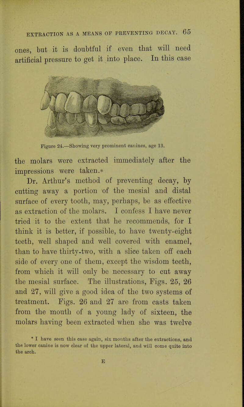 ones, but it is doubtful if even that will need artificial pressure to get it into place. In this case Figure 24.—Showing very prominent canines, age 13. the molars were extracted immediately after the impressions were taken.* Dr. Arthur's method of preventing decay, by cutting away a portion of the mesial and distal surface of every tooth, may, perhaps, be as effective as extraction of the molars. I confess I have never tried it to the extent that he recommends, for I think it is better, if possible, to have twenty-eight teeth, well shaped and well covered with enamel, than to have thirty-two, with a slice taken off each side of every one of them, except the wisdom teeth, from which it will only be necessary to cut away the mesial surface. The illustrations, Figs. 25, 26 and 27, will give a good idea of the two systems of treatment. Figs. 26 and 27 are from casts taken from the mouth of a young lady of sixteen, the molars having been extracted when she was twelve * I have seen this case again, six months after the extractions, and the lower canine is now clear of the upper lateral, aud will come quite into the arch. E