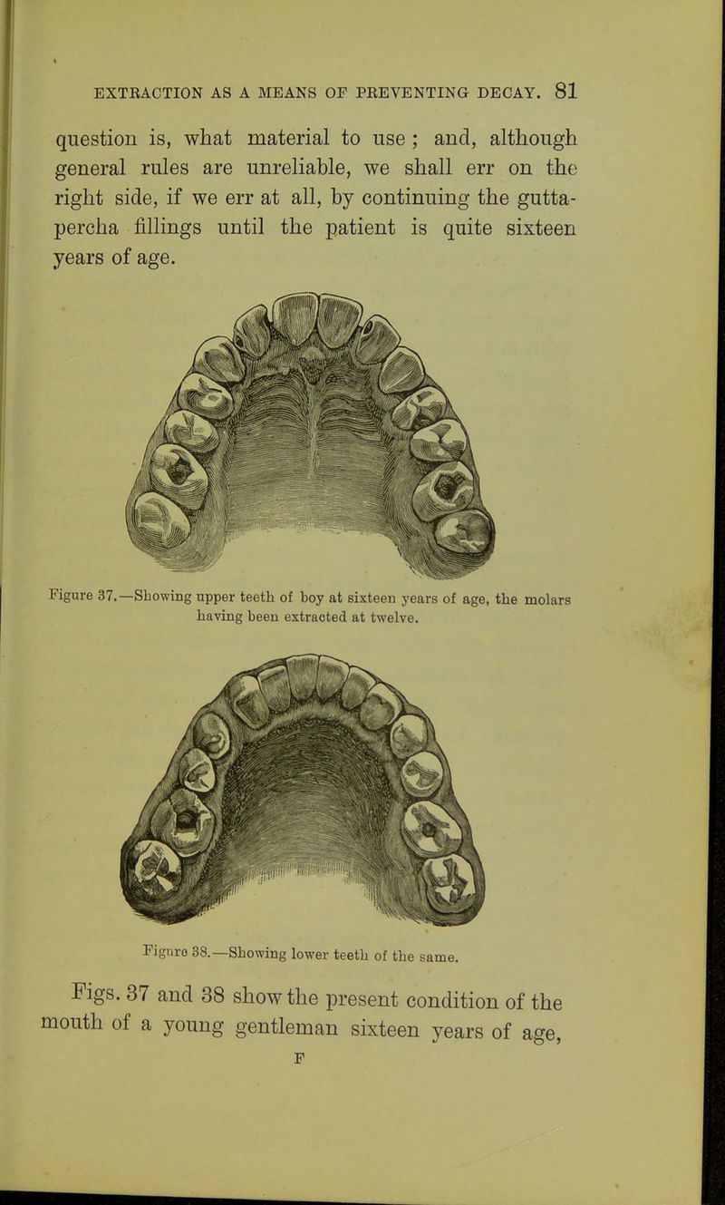 question is, what material to use ; and, although general rules are unreliable, we shall err on the right side, if we err at all, by continuing the gutta- percha fillings until the patient is quite sixteen years of age. Figure 37.—Showing upper teeth of hoy at sixteen years of age, the molars having heen extracted at twelve. Fignro 38.—Showing lower teeth of the same. Figs. 37 and 38 show the present condition of the outh of a young gentleman sixteen years of age, F