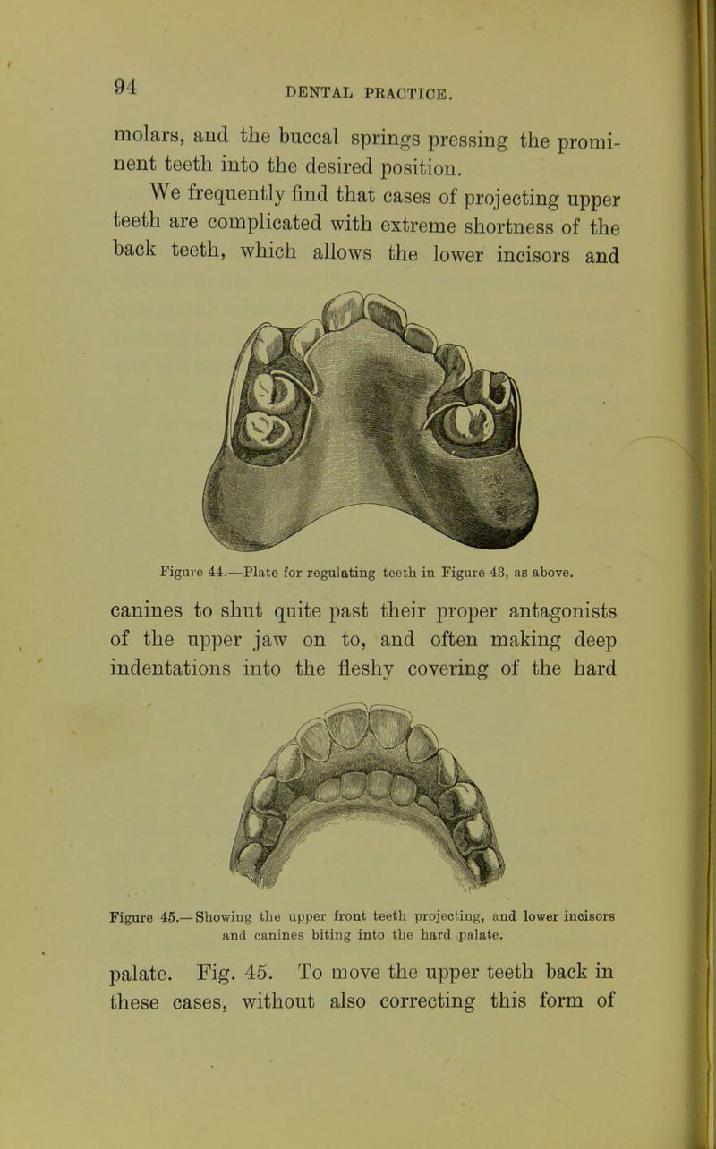 molars, and the buccal springs pressing the promi- nent teeth into the desired position. We frequently find that cases of projecting upper teeth are complicated with extreme shortness of the back teeth, which allows the lower incisors and Figure 44.—Plate for regulating teeth in Figure 43, as above. canines to shut quite past their proper antagonists of the upper jaw on to, and often making deep indentations into the fleshy covering of the hard Figure 45.—Showing the upper front teeth projecting, and lower incisors and canines biting into the hard palate. palate. Fig. 45. To move the upper teeth back in these cases, without also correcting this form of