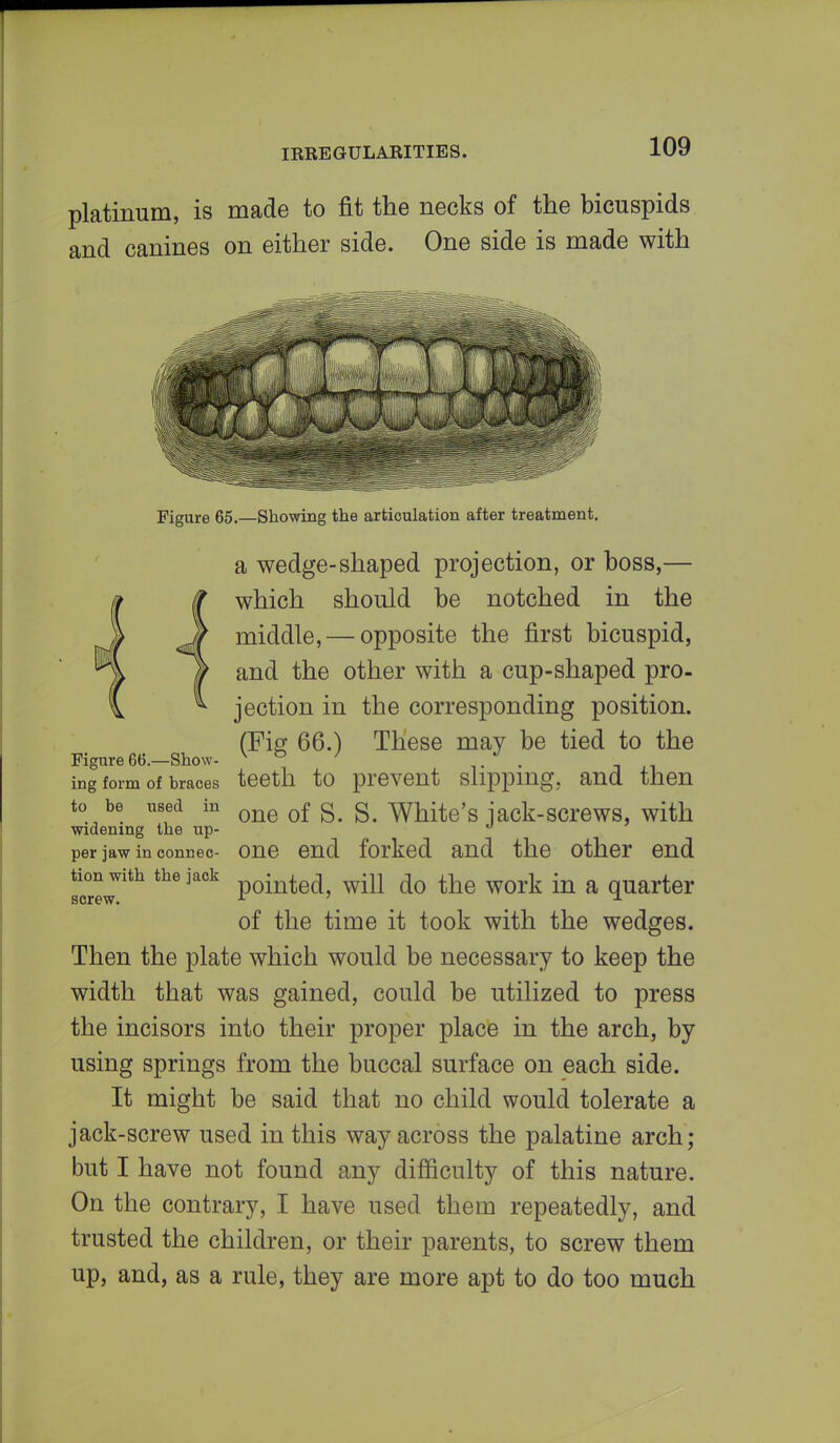 platinum, is made to fit the necks of the bicuspids and canines on either side. One side is made with Figure 65.—Showing the articulation after treatment. a wedge-shaped projection, or boss,— which should be notched in the middle, — opposite the first bicuspid, and the other with a cup-shaped pro- jection in the corresponding position. (Fig 66.) These may be tied to the Figure 66.—Show- v & 7 . ing form of hraces teeth to prevent slipping,, and then to be used in 0ne of S. S. White's jack-screws, with widening the up- per jaw in connec- One end forked and the other end tion with the jack pointed m do faQ WQrk in ft quarter screw. 1 u of the time it took with the wedges. Then the plate which would be necessary to keep the width that was gained, could be utilized to press the incisors into their proper place in the arch, by using springs from the buccal surface on each side. It might be said that no child would tolerate a jack-screw used in this way across the palatine arch; but I have not found any difficulty of this nature. On the contrary, I have used them repeatedly, and trusted the children, or their parents, to screw them up, and, as a rule, they are more apt to do too much