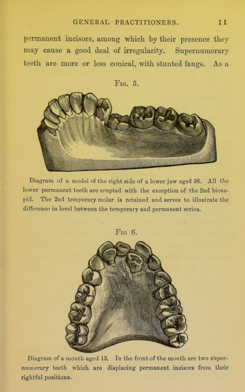 permanent incisors, among which by their presence they may cause a good deal of irregularity. Supernumerary teeth are more or less conical, with stunted fangs. As a Fig. 5. Diagram of a model of the right side of a lower jaw aged 36. All the lower permanent teeth are erupted with the exception of the 2nd bicus- pid. The 2nd temporary molar is retained and serves to illusti’ate the difference in level between the temporary and permanent series. Fig 6. Diagram of a mouth aged 13. In the front of the mouth are two super- numerary teeth which are displacing permanent incisors from their rightful positions.