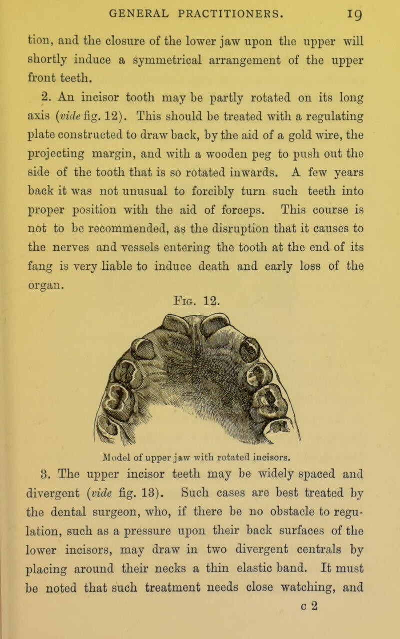 tion, and tlie closure of the lower jaw upon the upper will shortly induce a symmetrical arrangement of the upper front teeth. 2. An incisor tooth may be partly rotated on its long axis (vide fig. 12). This should be treated with a regulating plate constructed to draw back, by the aid of a gold wire, the projecting margin, and with a wooden peg to push out the side of the tooth that is so rotated inwards. A few years back it was not unusual to forcibly turn such teeth into proper position with the aid of forceps. This course is not to be recommended, as the disruption that it causes to the nerves and vessels entering the tooth at the end of its fang is very liable to induce death and early loss of the organ. Fig. 12. Model of upper jaw with rotated incisors. 3. The upper incisor teeth may be widely spaced and divergent (vide fig. 13). Such cases are best treated by the dental surgeon, who, if there be no obstacle to regu- lation, such as a pressure upon their back surfaces of the lower incisors, may draw in two divergent centrals by placing around their necks a thin elastic band. It must be noted that such treatment needs close watching, and c 2