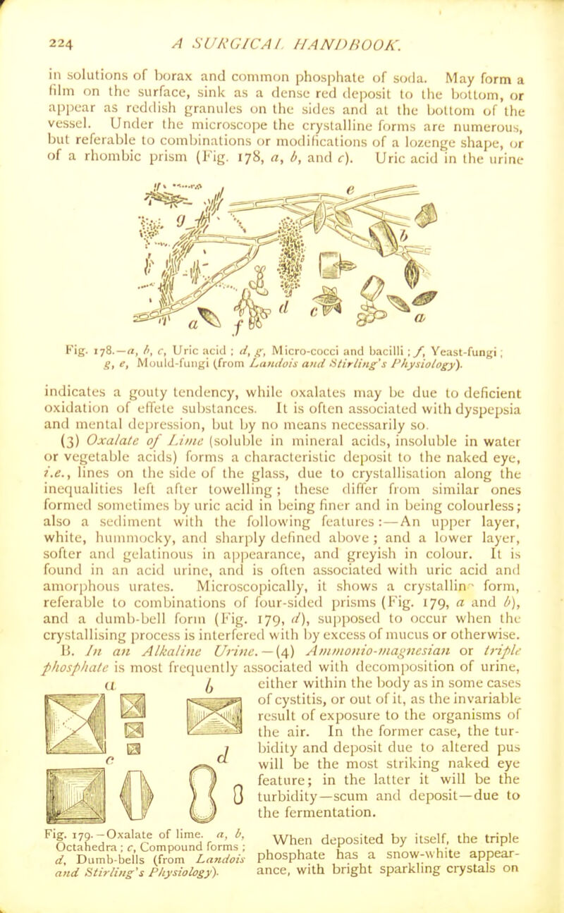r 224 A SURGICAL HANDBOOK. in solutions of borax and common phosphate of s(j(la. May form a lihn on the surface, sink as a dense red deposit to the bottom, or appear as reddish granules on the sides and at the bottom of the vessel. Under the microscope the crystalline forms are numerous, but referable to combinations or modifications of a lozenge shape, or of a rhombic prism (Fig. 178, a, b, and c). Uric acid in the urine Fig. 178.—n, /', f, Uric acid ; d, Micro-cocci and bacilli ; /, Yeast-fungi; g, e, Mould-fungi (from Landois and Utirling's Physiology). indicates a gouty tendency, while oxalates may be due to deficient oxidation of effete substances. It is often associated with dyspepsia and mental depression, but by no means necessarily so. (3) Oxalate of Lime (soluble in mineral acids, insoluble in water or vegetable acids) forms a characteristic deposit to the naked eye, i.e., lines on the side of the glass, due to crystallisation along the inequalities left after towelling; these differ from similar ones formed sometimes by uric acid in being finer and in being colourless; also a sediment with the following features:—An upper layer, white, hummocky, and sharjily defined above; and a lower layer, softer and gelatinous in ap]3earance, and greyish in colour. It is found in an acid urine, and is often associated with uric acid and amorphous urates. Microscopically, it shows a crystallin ■ form, referable to combinations of four-sided prisms (Fig. 179, a and b), and a dumb-bell form (Fig. 179, d), supposed to occur when the crystallising process is interfered with by excess of mucus or otherwise. B. In an Alkaline Urine. —{£,) Aninionio-tiiai^nesia7i or tt-iple phosphale is most frequently associated with decomposition of urine, either within the body as in some cases of cystitis, or out of it, as the invariable result of exposure to the organisms of the air. In the former case, the tur- bidity and deposit due to altered pus will be the most striking naked eye feature; in the latter it will be the turbidity—scum and deposit—due to the fermentation. When deposited by itself, the triple phosphate has a snow-white appear- ance, with bright sparkling ciystals on Fig. 179.—Oxalate of lime, a, b. Octahedra ; r, Compound forms ; d. Dumb-bells (from Landois and Siirliiig's Physiology).