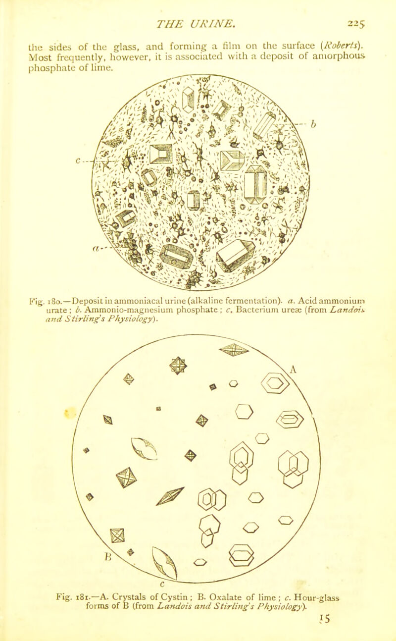 tlie sides of the glass, and forming a film on the surface [Roberts). Most frequently, however, it is associated with a deposit of amorphous, phosphate of lime.