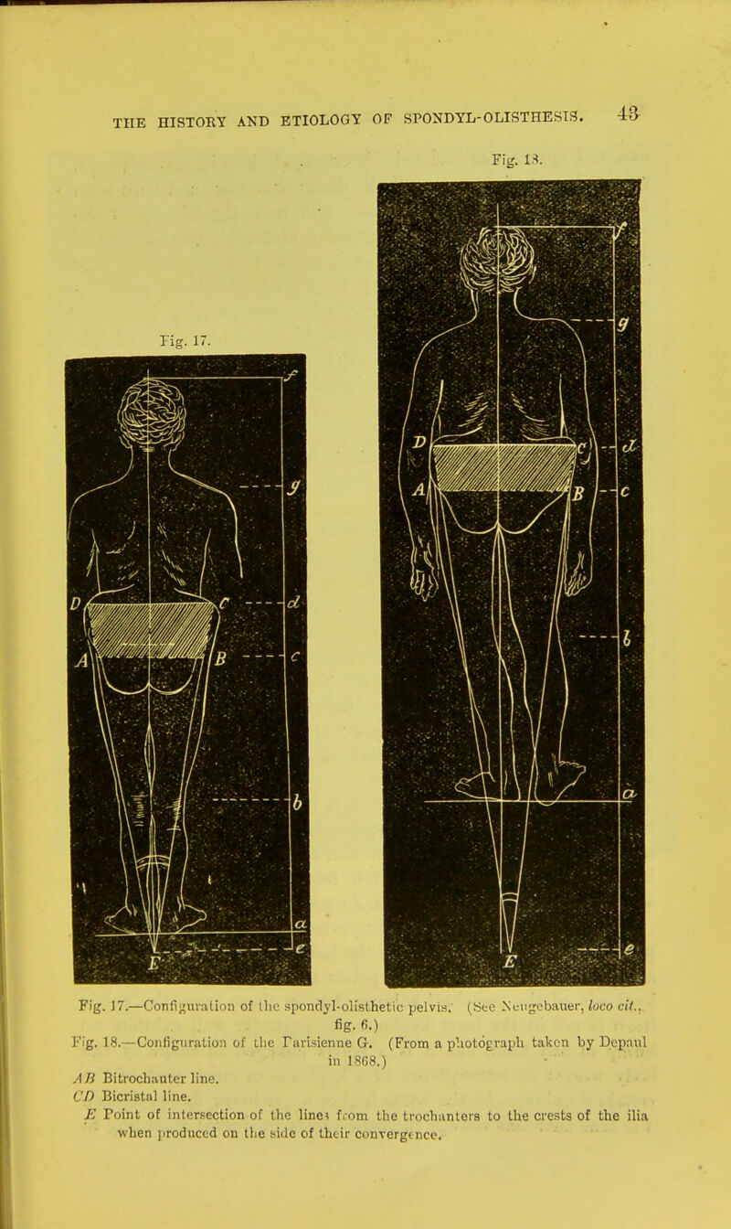 Fig. £3. Fig. 17.—Configuration of the spondylolisthetic pelvis. (Sec Ncugebauer, loco cit.. fig. «.) Fig. 18.—Configuration of the Tarisienne G. (From a photograph taken by Dcpaul in 1808.) AB Bitrocliauter line. CD Bicristal line. E Point of intersection of the line* from the trochanters to the crests of the ilia when produced on the side of their convergence.