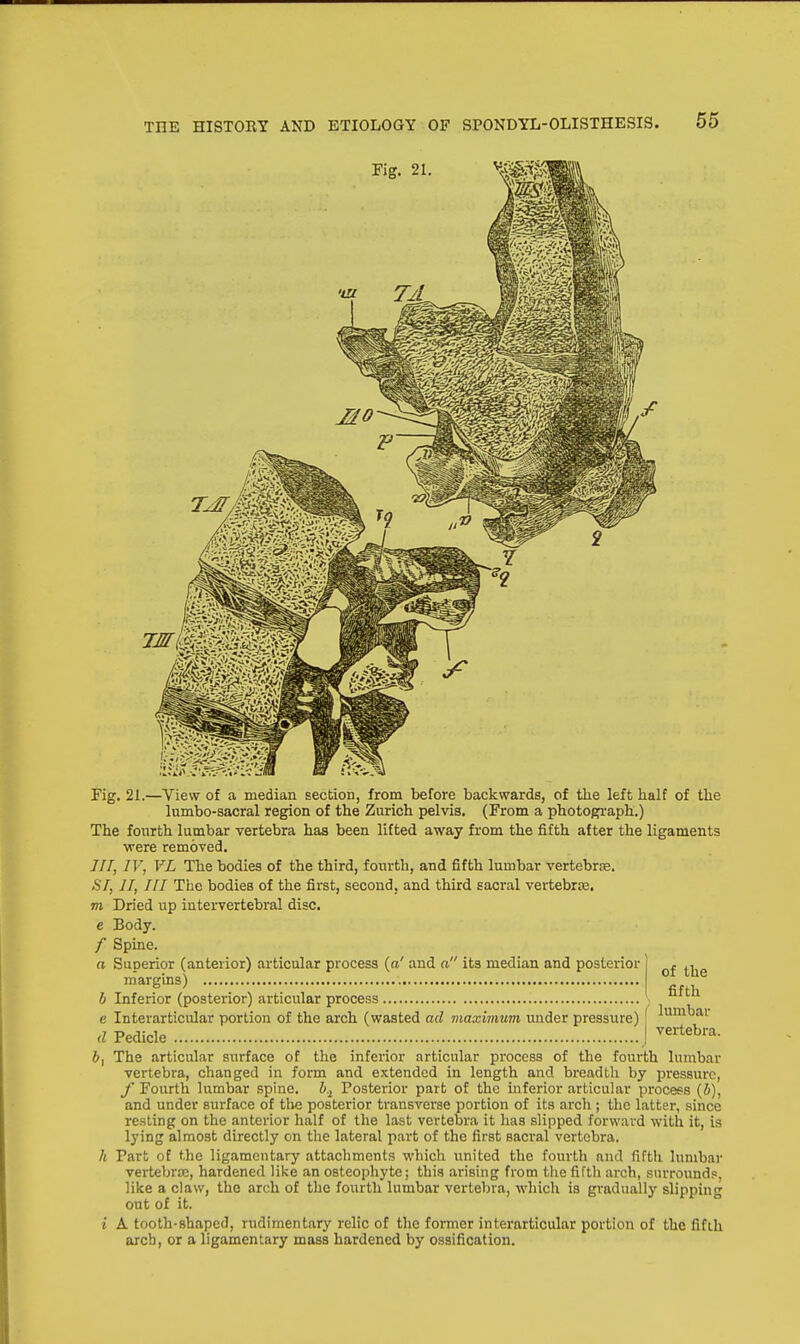 Fig. 21. 7fflm0k Fig. 21.—View of a median section, from before backwards, of the left half of the lumbo-sacral region of the Zurich pelvis. (From a photograph.) The fourth lumbar vertebra has been lifted away from the fifth after the ligaments were removed. 777, IV, VL The bodies of the third, fourth, and fifth lumbar vertebra. SI, 11, III The bodies of the first, second, and third sacral vertebrae, m Dried up intervertebral disc. c Body. f Spine. a Superior (anterior) articular process (a' and a its median and posterior margins) b Inferior (posterior) articular process e Interarticular portion of the arch (wasted ad maximum under pressure) d Pedicle of the fifth lumbar vertebra. The articular surface of the inferior articular process of the fourth lumbar vertebra, changed in form and extended in length and breadth by pressure, f Fourth lumbar spine. b.x Posterior part of the inferior articular process (b), and under surface of the posterior transverse portion of its arch ; the latter, since resting on the anterior half of the last vertebra it has slipped forward with it, is lying almost directly on the lateral part of the first sacral vertebra. Part of the ligamentary attachments which united the fourth ami fifth lumbar vertebra;, hardened like an osteophyte; this arising from the fifth arch, surrounds, like a claw, the arch of the fourth lumbar vertebra, which is gradually slipping out of it. A tooth-shaped, rudimentary relic of the former interarticular portion of the fifth arcb, or a ligamentary mass hardened by ossification.