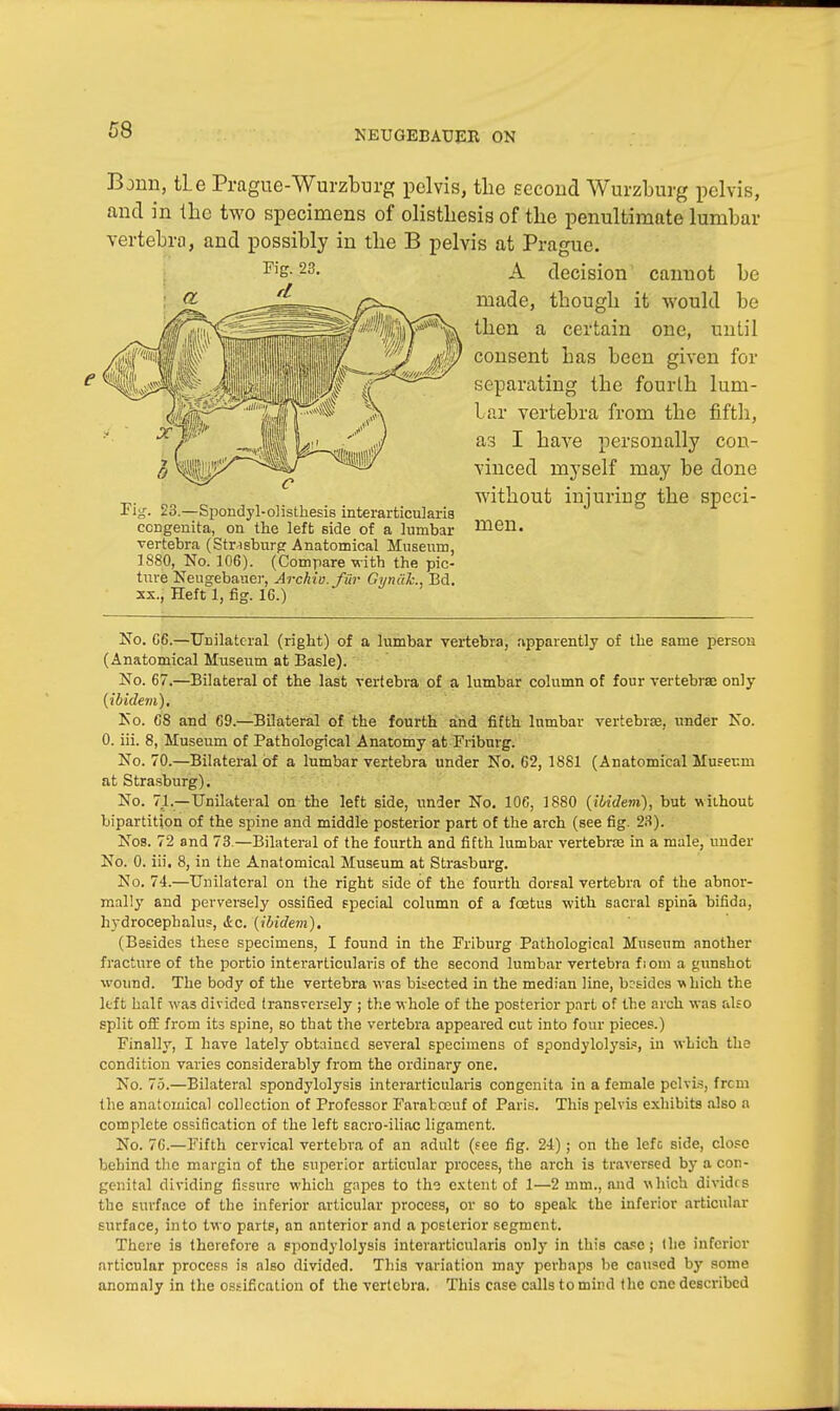 Bjnn, tLe Prague-Wurzburg pelvis, the second Wurzburg pelvis, and in the two specimens of olistliesis of the penultimate lumbar vertebra, and possibly in the B pelvis at Prague. A decision cannot be made, though it would be then a certain one, until consent has been given for separating the fourth lum- bar vertebra from the fifth, as I have personally con- vinced myself may be done without injuring the speci- men. No. G6.—Unilateral (right) of a lumbar vertebra, apparently of the same person (Anatomical Museum at Basle). No. 67.—Bilateral of the last vertebra of a lumbar column of four vertebra: only {ibidem). No. G8 and 69.—Bilateral of the fourth and fifth lumbar vertebrae, under No. 0. iii. 8, Museum of Pathological Anatomy at Friburg. No. 70.—Bilateral of a lumbar vertebra under No. 62, 1881 (Anatomical Museum at Strasburg). No. 71.—Unilateral on the left side, under No. 10C, 1880 (ibidem), but without bipartition of the spine and middle posterior part of the arch (see fig. 23). Nos. 72 and 73.—Bilateral of the fourth and fifth lumbar vertebrae in a male, under No. 0. iii. 8, in the Anatomical Museum at Strasburg. No. 74.—Unilateral on the right side of the fourth dorsal vertebra of the abnor- mally and perversely ossified special column of a foetus with sacral spina bifida, hydrocephalus, &c. (ibidem). (Besides these specimens, I found in the Friburg Pathological Museum another fracture of the portio interarticularis of the second lumbar vertebra f; om a gunshot wound. The body of the vertebra was bisected in the median line, besides which the kit half was divided transversely ; the whole of the posterior part of the arch was also split off from its spine, so that the vertebra appeared cut into four pieces.) Finally, I have lately obtained several specimens of spondylolysis, in which the condition varies considerably from the ordinary one. No. 75.—Bilateral spondylolysis interarticularis congenita in a female pelvis, frcm the anatomical collection of Professor Faratceuf of Paris. This pelvis exhibits also a complete ossification of the left sacro-iliac ligament. No. 76.—Fifth cervical vertebra of an adult (fee fig. 24); on the lefc side, close behind the margin of the superior articular process, the arch is traversed by a con- genital dividing fissure which gapes to the extent of 1—2 mm., and which divides the surface of the inferior articular process, or so to speak the inferior articular surface, into two parts, an anterior and a posterior segment. There is therefore a spondylolysis interarticularis only in this case; the inferior articular process is also divided. This variation may perhaps be caused by some anomaly in the ossification of the vertebra. This case calls to mind the one described Fig. 23. congenita, on the left side of a lumbar vertebra (Stwsburg Anatomical Museum, 1880, No. 106). (Compare with the pic- ture Neugebauer, Archio.fur Gynak., Bd.