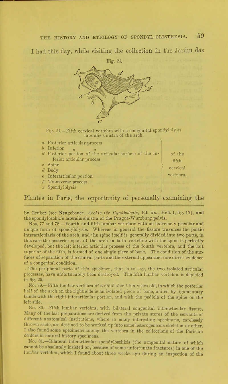 I had this clay, while visiting the collection in the Jarclin de3 Fig. 21. Fig. 24.—Fifth cervical vertebra with a congenital spDactylolysis lateralis s:nistra of the arch. a Posterior articular process b Inferior „ „ b' Posterior portion of the articular surface of the in- ferior articular process c Spine d Body e Interarticular portion f Transverse process x Spondylolysis of the fifth cervical vertebra. Plantes in Paris, the opportunity of personally examining the by Gruber (see Neugebauer, Archivjur Gyndkologie, Bd. xx., Heft 1, fig. 12), and the spondyloschiz:s lateralis sinistra of the Prague-Wurzburg pelvis. Nos. 77 and 78.—Fourth and fifth lumbar vertebrae with an extremely peculiar and unique form of spondylolysis. Whereas in general the fissure traverses the portio interarticnlaris of the arch, and the spine itself is generally divided into two parts, in this case the posterior span of the arch in both vertebras with the spine is perfectly developed, but the left inferior articular process of the fourth vertebra, and the left superior of the fifth, is formed of one single piece of bone. The condition of the sur- faces of separation of the central parts and the external appearance are direct evidence of a congenital condition. • The peripheral part3 of th's specimen, that is to say, the two isolated articular processes, have unfortunately teen destroyed. The fifth lumbar vertebra is depicted in fig. 25. No. 79.—Fifth lumbar vertebra of a child about ten years old, in which the posterior half of the arch cn the right side is an isolated piece of bone, united by ligamentary bands with the right interarticular portion, and with the pedicle of the spine on the left side. No. 80.—Fifth lumbar vertebra, with bilateral congenital interarticular fissure. Many of the last preparations are derived from the private stores of the servants of different anatomical institutions, where so many interesting specimens, carelessly thrown aside, are destined to be worked up into some heterogeneous skeleton or other. I also found some specimens among the vertebra in the collections of the Parisian dealers in natural history specimens. No. 81.—Bilateral interarticular spondyloschizis (the ongenital nature of which cannot be absolutely insisted on, because of some unfortunate fractures) in one of the lumbar verteb-a, which I found about three weeks ago during an inspection of the