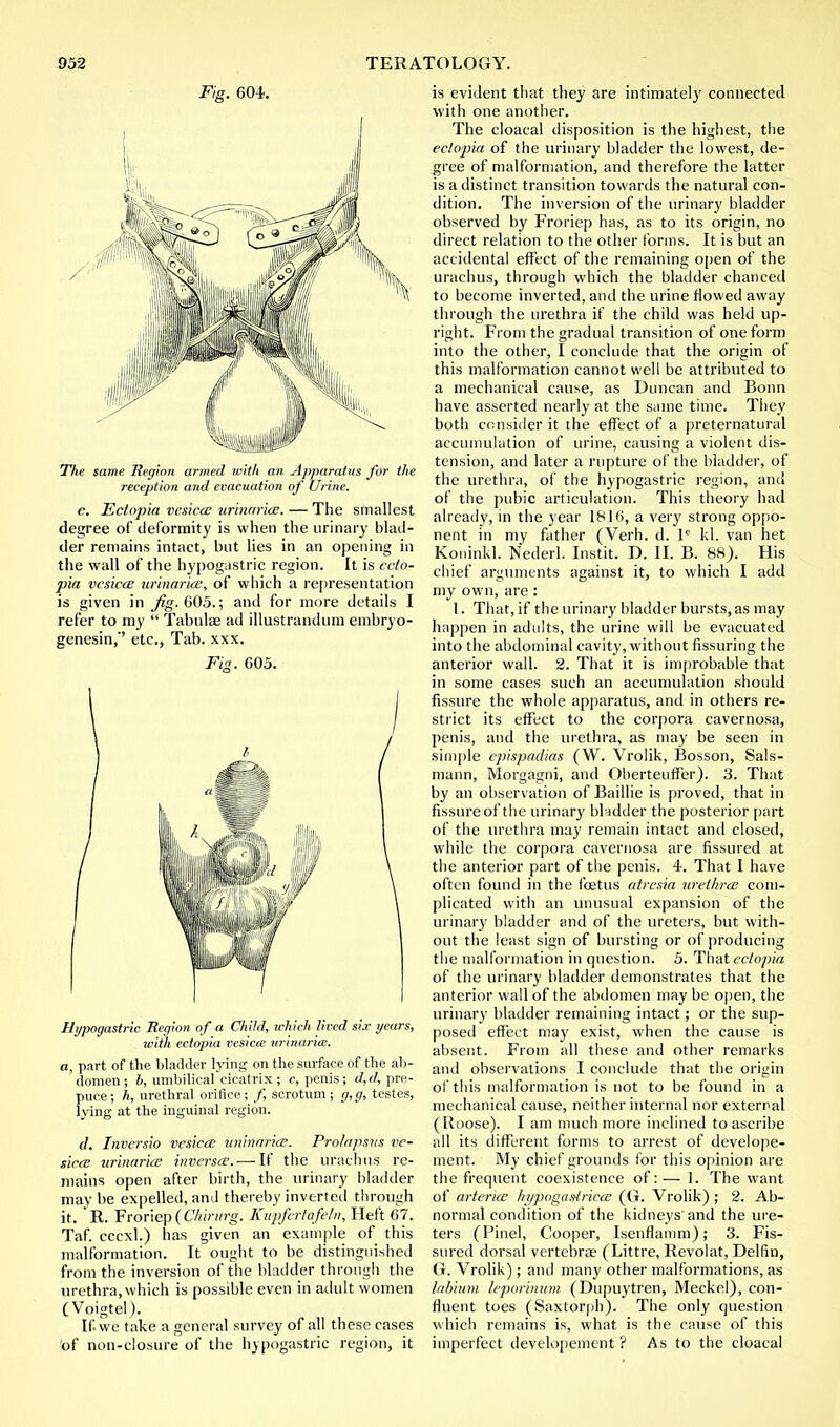 Fig. 604. The same Region armed with an Apparatus for the reception and evacuation of Urine. c. Ectopia vesica; urinaria?. — The smallest degree of deformity is when the urinary blad- der remains intact, but lies in an opening in the wall of the hypogastric region. It is ecto- pia vesica; urinaria?, of which a representation is given in Jig. 605.; and for more details I refer to my  Tabulae ad illustrandum embryo- genesin,'' etc., Tab. xxx. Fig. 605. Hypogastric Region of a Child, which lived six years, with ectopia vesicce urinaria. a, part of the bladder lying on the surface of the ab- domen ; b, umbilical cicatrix ; c, penis ; d, d, pre- puce ; h, urethral orifice; /, scrotum; g,g, testes, lying at the inguinal region. (/. Invcrsio vesica: urinaria?. Pro/apsus ve- sica; urinaria? inverse.— If the urachus re- mains open after birth, the urinary bladder may be expelled, and thereby inverted through it. R. Fronep(C/iirnrg. Kupfertafeln, Heft 67. Taf. cccxl.) has given an example of this malformation. It ought to be distinguished from the inversion of the bladder through the urethra, which is possible even in adult women (Voigtel). If. we take a general survey of all these cases of non-closure of the hypogastric region, it is evident that they are intimately connected with one another. The cloacal disposition is the highest, the ectopia of the urinary bladder the lowest, de- gree of malformation, and therefore the latter is a distinct transition towards the natural con- dition. The inversion of the urinary bladder observed by Froriep has, as to its origin, no direct relation to the other forms. It is but an accidental effect of the remaining open of the urachus, through which the bladder chanced to become inverted, and the urine flowed away through the urethra if the child was held up- right. From the gradual transition of one form into the other, I conclude that the origin of this malformation cannot well be attributed to a mechanical cause, as Duncan and Bonn have asserted nearly at the same time. They both consider it the effect of a preternatural accumulation of urine, causing a violent dis- tension, and later a rupture of the bladder, of the urethra, of the hypogastric region, and of the pubic articulation. This theory had already, in the year 1816, a very strong oppo- nent in my father (Verh. d. le kl. van het Koninkl. Nederl. Instit. I). II. B. 88). His chief arguments against it, to which I add my own, are: I. That, if the urinary bladder bursts,as may happen in adults, the urine will be evacuated into the abdominal cavity, without Assuring the anterior wall. 2. That it is improbable that in some cases such an accumulation should fissure the whole apparatus, and in others re- strict its effect to the corpora cavernosa, penis, and the urethra, as may be seen in simple epispadias (W. Vrolik, Bosson, Sals- mann, Morgagni, and Oberteuffer). 3. That by an observation of Baillie is proved, that in fissure of the urinary bladder the posterior part of the urethra may remain intact and closed, while the corpora cavernosa are fissured at the anterior part of the penis. 4. That I have often found in the fcetus atresia urethra; com- plicated with an unusual expansion of the urinary bladder and of the ureters, but with- out the least sign of bursting or of producing the malformation in question. 5. That ectopia of the urinary bladder demonstrates that the anterior wall of the abdomen may be open, the urinary bladder remaining intact; or the sup- posed effect may exist, when the cause is absent. From all these and other remarks and observations I conclude that the origin of this malformation is not to be found in a mechanical cause, neither internal nor external (Roose). I am much more inclined to ascribe all its different forms to arrest of develope- ment. My chief grounds for this opinion are the frequent coexistence of: — 1. The want of arteries Iii/pogaHrica? (G. Vrolik) ; 2. Ab- normal condition of the kidneys and the ure- ters (Pinel, Cooper, Isenflamm); 3. Fis- sured dorsal vertebra? (Littre, Revolat, Delfin, G. Vrolik); and many other malformations, as labium leporinum (Dupuytren, Meckel), con- fluent toes (Saxtorph). The only question which remains is, what is the cause of this imperfect developement ? As to the cloacal