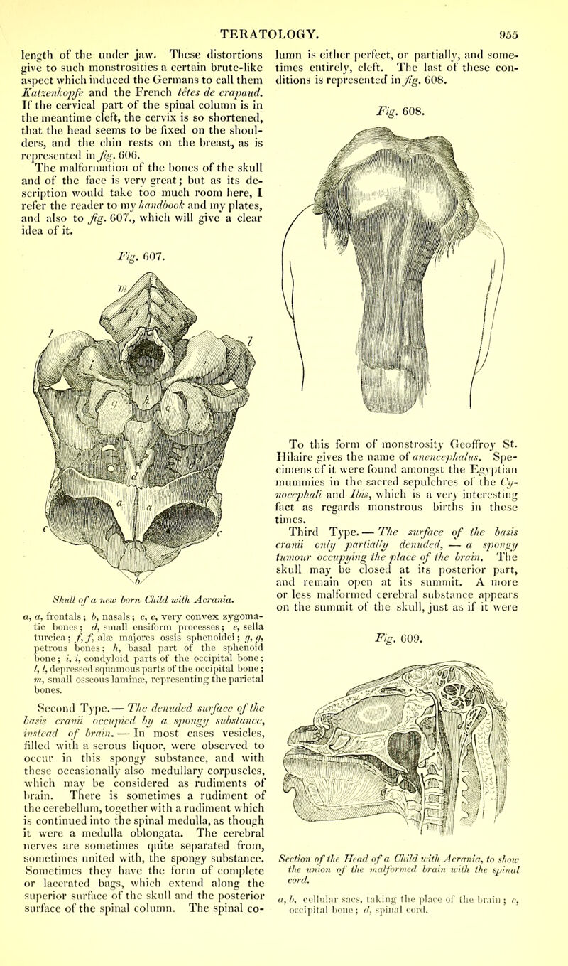 length of the under jaw. These distortions give to such monstrosities a certain brute-like aspect which induced the Germans to call them KatzerJcopfe and the French tctes de crapaud. If the cervical part of the spinal column is in the meantime cleft, the cervix is so shortened, that the head seems to be fixed on the shoul- ders, and the chin rests on the breast, as is represented in fig. 606. The malformation of the bones of the skull and of the face is very great; but as its de- scription would take too much room here, I refer the reader to my handbook and my plates, and also to fig. 007., which will give a clear idea of it. Fie. 607. Shdl of a new born Child with Acrania. a, a, frontals; b, nasals; c, c, very convex zygoma- tic bones; d, small ensiform processes; e, sella turcica; f,f, ala3 majores ossis sphenoidei; g, g, petrous bones; h, basal part of the sphenoid bone; i, i, condyloid parts of the occipital bone; /, /, depressed squamous parts of the occipital bone ; m, small osseous laminae, representing the parietal bones. Second Type.— The denuded surface of the basis cranii occupied by a spongy substance, instead of brain. — In most cases vesicles, filled with a serous liquor, were observed to occur in this spongy substance, and with these occasionally also medullary corpuscles, which may be considered as rudiments of brain. There is sometimes a rudiment of the cerebellum, together with a rudiment which is continued into the spinal medulla, as though it were a medulla oblongata. The cerebral nerves are sometimes quite separated from, sometimes united with, the spongy substance. Sometimes they have the form of complete or lacerated bags, which extend along the superior surface of the skull and the posterior surface of the spinal column. The spinal co- lumn is either perfect, or partially, and some- times entirely, cleft. The last of these con- ditions is represented vnjig. 608. Fig, 608. To this form of monstrosity Geoffroy St. Hilaire gives the name of anencephalns. Spe- cimens of it were found amongst the Egyptian mummies in the sacred sepulchres of the Cy- nocephali and Ibis, which is a very interesting fact as regards monstrous births in these times. Third Type.— The surface of the basis cranii only partially denuded, — a spongy tumour occupying the place of the brain. The skull may be closed at its posterior part, and remain open at its summit. A more or less malformed cerebral substance appears on the summit of the skull, just as if it were Fig. 609. Section o f the Head of a Child with Acrania, to show the union of the malformed brain icilh the spinal cord. a, I', cellular sacs, taking the place of the brain ; c, occipital bone; d, spinal cord.