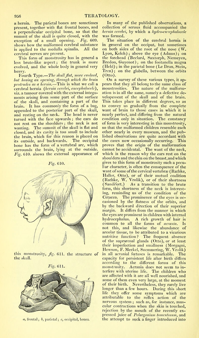 a hernia. The parietal hones are sometimes present, together with flat frontal bones, and a perpendicular occipital bone, so that the summit of the skull is quite closed, with the exception of a small opening. Fig. 609. shows how the malformed cerebral substance is applied to the medulla spinalis. All the cerebral nerves are present. This form of monstrosity has in general a less brute-like aspect; the trunk is more evolved, and the whole body in general very heavy. Fourth Type.—The skullflat, more evolved, but having an opening, through which the brain protrudes as a hernia.—This is what we call a cerebral hernia {hernia cerebri, encephalocele), viz. a tumour covered with the external integu- ments arising from some part of the surface of the skull, and containing a part of the brain. It has commonly the form of a bag, appended to the posterior part of the skull, and resting on the neck. The head is never turned with the face upwards ; the ears do not rest on the shoulders ; the neck is not wanting. The summit of the skull is flat and closed, and its cavity is too small to include the brain, which for this reason is placed on its outside, and backwards. The occipital bone has the form of a vertebral arc, which surrounds the brain, lying at the outside. Fig. 610. shows the external appearance of Fig. 610. this monstrosity, Jig. 611. the structure of the skull. Fig. 611. a, frontal; b, parietal; c, occipital, bones. In many of the published observations, a collection of serous fluid accompanied the hernia cerebri, by which a hydro-encephalocele was formed. The situation of the cerebral hernia is in general on the occiput, but sometimes on both sides of the root of the nose (W. Lyon, Kelch) ; above the eye (Adams); on the forehead (Beclard, Saxtorph, Niemeyen, Bredon, Guyenot) ; on the fontanella magna (Held) ; in the parietal bone (Le Dran, Stein, Tren) ; on the glabella, between the orbits (Otto). On a survey of these various types, it ap- pears that they all belong to the same class of monstrosities. The nature of the malform- ation is in all the same, namely a defective de- velopement of the skull and of the brain. This takes place in different degrees, so as to convey us gradually from the complete want of brain to those cases in which it is nearly perfect, and differing from the natural condition only in situation. The constancy of form is very interesting in this monstrosity, so that the malformed children resemble each other nearly in every museum, and the pub- lished observations are quite accordant with the cases now occasionally occurring. This proves that the origin of the malformation cannot be accidental. The want of the neck, which is the reason why the ears rest on the shoulders and the chin on the breast, and which gives to this form of monstrosity such a pecu- liar character, is often the consequence of the want of some of the cervical vertebra; (Rathke, Haller, Otto), or of their mutual coalition (Rathke, W. Vrolik), or of their shortness (Sandifort.) As a transition to the brute form, this shortness of the neck is interest- ing, reminding us of the condition of the Cetacea. The prominence of the eyes is oc- casioned by the flatness of the orbits, and by the backward direction of their superior margin. It differs from the manner in which the eyes are prominent in children with internal hydrocephalus. A rich growth of hair is common to all the forms of acrania. Is not this, and likewise the abundance of areolar tissue, to be attributed to a vicarious nutritive function ? The frequent absence of the suprarenal glands (Otto), or at least their imperfection and smallness (Morgagni, Hewson, F. Meckel, Soemmering, W. Vrolik) in all acranial foetuses is remarkable. The capacity for persistent life after birth differs according to the different forms of this monstrosity. Acrania does not seem to in- terfere with uterine life. The children who are affected with it are all well nourished, and some of them even very large, at the moment of their birth. Nevertheless, they rarely live longer than a few hours. During this short life they offer some symptoms which are attributable to the reflex action of the nervous system ; such as, for instance, mus- cular contractions when the skin is touched, rejection by the mouth of the recently ex- pressed juice of Pelargonium tomcntosum, and the attempt to suck a finger introduced into