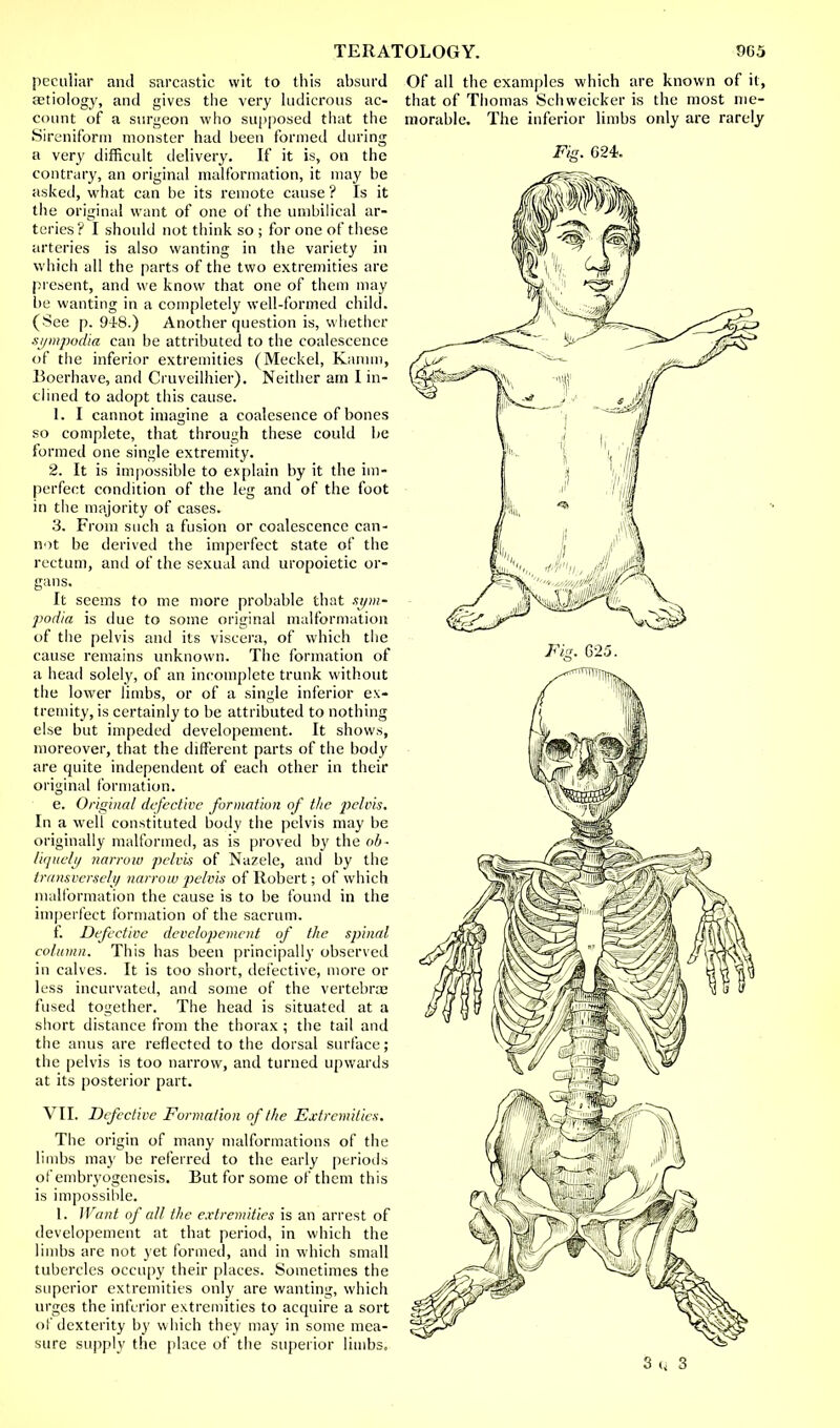 peculiar and sarcastic wit to this absurd aetiology, and gives the very ludicrous ac- count of a surgeon who supposed that the Sireniform monster had been formed during a very difficult delivery. If it is, on the contrary, an original malformation, it may be asked, what can be its remote cause ? Is it the original want of one of the umbilical ar- teries ? I should not think so ; for one of these arteries is also wanting in the variety in which all the parts of the two extremities are present, and we know that one of them may be wanting in a completely well-formed child. (See p. 948.) Another question is, whether sj/mpodia can be attributed to the coalescence of the inferior extremities (Meckel, Karam, Boerhave, and Cruveilhier). Neither am I in- clined to adopt this cause. 1. I cannot imagine a coalesence of bones so complete, that through these could be formed one single extremity. 2. It is impossible to explain by it the im- perfect condition of the leg and of the foot in the majority of cases. 3. From such a fusion or coalescence can- not be derived the imperfect state of the rectum, antl of the sexual and uropoietic or- gans. It seems to me more probable that gym- podia is due to some original malformation of the pelvis and its viscera, of which the cause remains unknown. The formation of a head solely, of an incomplete trunk without the lower limbs, or of a single inferior ex- tremity, is certainly to be attributed to nothing else but impeded developement. It shows, moreover, that the different parts of the body are quite independent of each other in their original formation. e. Original defective formation of the pelvis. In a well constituted body the pelvis may be originally malformed, as is proved by the ob~ liquely narroio pelvis of Nazele, and by the transversely narrow pelvis of Robert; of which malformation the cause is to be found in the imperfect formation of the sacrum. f. Defective developement of the spinal column. This has been principally observed in calves. It is too short, defective, more or less incurvated, and some of the vertebrae fused together. The head is situated at a short distance from the thorax ; the tail and the anus are reflected to the dorsal surface; the pelvis is too narrow, and turned upwards at its posterior part. VII. Defective Formation of the Extremities. The origin of many malformations of the limbs may be referred to the early periods of embryogenesis. But for some of them this is impossible. 1. Want of all the extremities is an arrest of developement at that period, in which the limbs are not yet formed, and in which small tubercles occupy their places. Sometimes the superior extremities only are wanting, which urges the inferior extremities to acquire a sort of dexterity by which they may in some mea- sure supply the place of the superior limbs. Of all the examples which are known of it, that of Thomas Schwcicker is the most me- morable. The inferior limbs only are rarely Fig. G24. 3ii 3