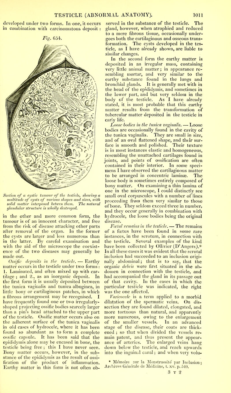 developed under two forms. In one, it occurs in combination with carcinomatous deposit : Fig. 65L Section of a cystic tumour of the testicle, showing a multitude of cysts of various shapes and sizes, with solid matte)- interposed betwen them. The natural glandular structure is wholly destroyed. in the other and more common form, the tumour is of an innocent character, and free from the risk of disease attacking other parts after removal of the organ. In the former the cysts are larger and less numerous than in the latter. By careful examination and with the aid of the microscope the coexist- ence of the two diseases may generally be made out. Ossific deposits in the testicle. — Earthy matter occurs in the testicle under two forms : 1. Laminated, and often mixed up with car- tilage ; and 2., as an inorganic deposit. In the first form it is usually deposited between the tunica vaginalis and tunica albuginea, in little bony or cartilaginous patches, in which a fibrous arrangement may be recognised. I have frequently found one or two irregularly- shaped projecting ossific bodies scarcely larger than a pin's head attached to the upper part of the testicle. Ossific matter occurs also on the adherent surface of the tunica vaginalis in old cases of hydrocele, where it has been found so abundant as to form a complete ossific capsule. It has been said that the epididymis alone may be encased in bone, the testicle being free ; this I have never seen. Bony matter occurs, however, in the sub- stance of the epididymis as the result of ossi- fication of the product of inflammation. Earthy matter in this form is not often ob- served in the substance of the testicle. The gland, however, when atrophied and reduced to a mere fibrous tissue, occasionally under- goes both the cartilaginous and osseous trans- formation. The cysts developed in the tes- ticle, as I have already shown, are liable to similar changes. In the second form the earthy matter is deposited in an irregular mass, containing very little animal matter; in appearance re- sembling mortar, and very similar to the earthy substance found in the lungs and bronchial glands. It is generally met with in the head of the epididymis, and sometimes in the lower part, and but very seldom in the body of the testicle. As I have already stated, it is most probable that this earthy matter results from the transformation of tubercular matter deposited in the testicle in early life. Loose bodies in the tunica vaginalis. — Loose bodies are occasionally found in the cavity of the tunica vaginalis. They are small in size, and of an oval flattened shape, and their sur- face is smooth and polished. Their texture is in most instances elastic and homogeneous, resembling the unattached cartilages found in joints, and points of ossification are often contained in their interior. In some speci- mens I have observed the cartilaginous matter to be arranged in concentric laminae. The loose body is sometimes entirely composed of bony matter. On examining a thin lamina of one in the microscope, I could distinctly see small oval corpuscules with a number of lines proceeding from them very similar to those of bone. They seldom exceed three in number, and they occur generally in combination with hydrocele, the loose bodies being the original disease. Faelal remains in the testicle. — The remains of a foetus have been found in some rare instances, in the scrotum, in connection with the testicle. Several examples of the kind have been collected by Ollivier (D'Angers).* In all these cases it was evident that the scrotal inclusion had succeeded to an inclusion origi- nally abdominal; that is to say, that the organic debris were first situated in the ab- domen in connection with the testicle, and had accompaniad the gland in its passage out of that cavity. In the cases in which the particular testicle was indicated, the right was the one affected. Varicocele is a term applied to a morbid dilatation of the spermatic veins. On dis- section they are found dilated, elongated, and more tortuous than natural, and apparently more numerous, owing to the enlargement of the smaller vessels. In an advanced stage of the disease, their coats are thick- ened ; so that when divided the vessels re- main patent, and thus present the appear- ance of arteries. The enlarged veins hang down below the testicle, and reach upwards into the inguinal canal; and w hen very volu- * Memoire sur la Monstruosite par Inclusion; Archives Ge'ne'rale de Medicine, t. xv. p. 540.