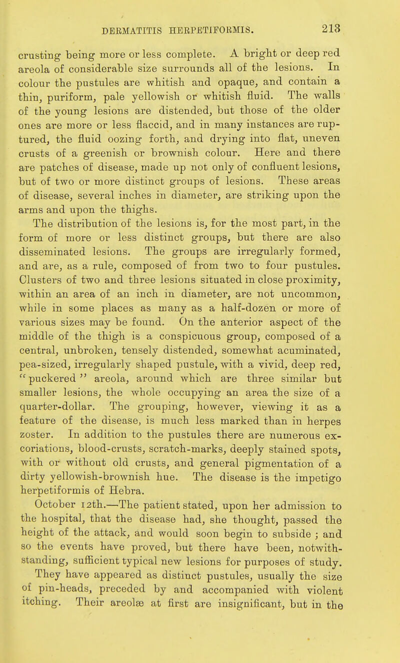 crusting being more or less complete. A bright or deep red areola of considerable size surrounds all of the lesions. In colour the pustules are whitish and opaque, and contain a thin, puriform, pale yellowish or whitish fluid. The walls of the young lesions are distended, but those of the older ones are more or less flaccid, and in many instances are rup- tured, the fluid oozing forth, and drying into flat, uneven crusts of a greenish or brownish colour. Here and there are patches of disease, made up not only of confluent lesions, but of two or more distinct groups of lesions. These areas of disease, several inches in diameter, are striking upon the arms and upon the thighs. The distribution of the lesions is, for the most part, in the form of more or less distinct groups, but there are also disseminated lesions. The groups are irregularly formed, and are, as a rule, composed of from two to four pustules. Clusters of two and three lesions situated in close proximity, within an area of an inch in diameter, are not uncommon, while in some places as many as a half-dozen or more of various sizes may be found. On the anterior aspect of the middle of the thigh is a conspicuous group, composed of a central, unbroken, tensely distended, somewhat acuminated, pea-sized, irregularly shaped pustule, with a vivid, deep red, puckered areola, around which are three similar but smaller lesions, the whole occupying an area the size of a quarter-dollar. The grouping, however, viewing it as a feature of the disease, is much less marked than in herpes zoster. In addition to the pustules there are numerous ex- coriations, blood-crusts, scratch-marks, deeply stained spots, with or without old crusts, and general pigmentation of a dirty yellowish-brownish hue. The disease is the impetigo herpetiformis of Hebra. October 12th.—The patient stated, upon her admission to the hospital, that the disease had, she thought, passed the height of the attack, and would soon begin to subside ; and so the events have proved, but there have been, notwith- standing, sufficient typical new lesions for purposes of study. They have appeared as distinct pustules, usually the size of pin-heads, preceded by and accompanied with violent itching. Their areolae at first are insignificant, but in the