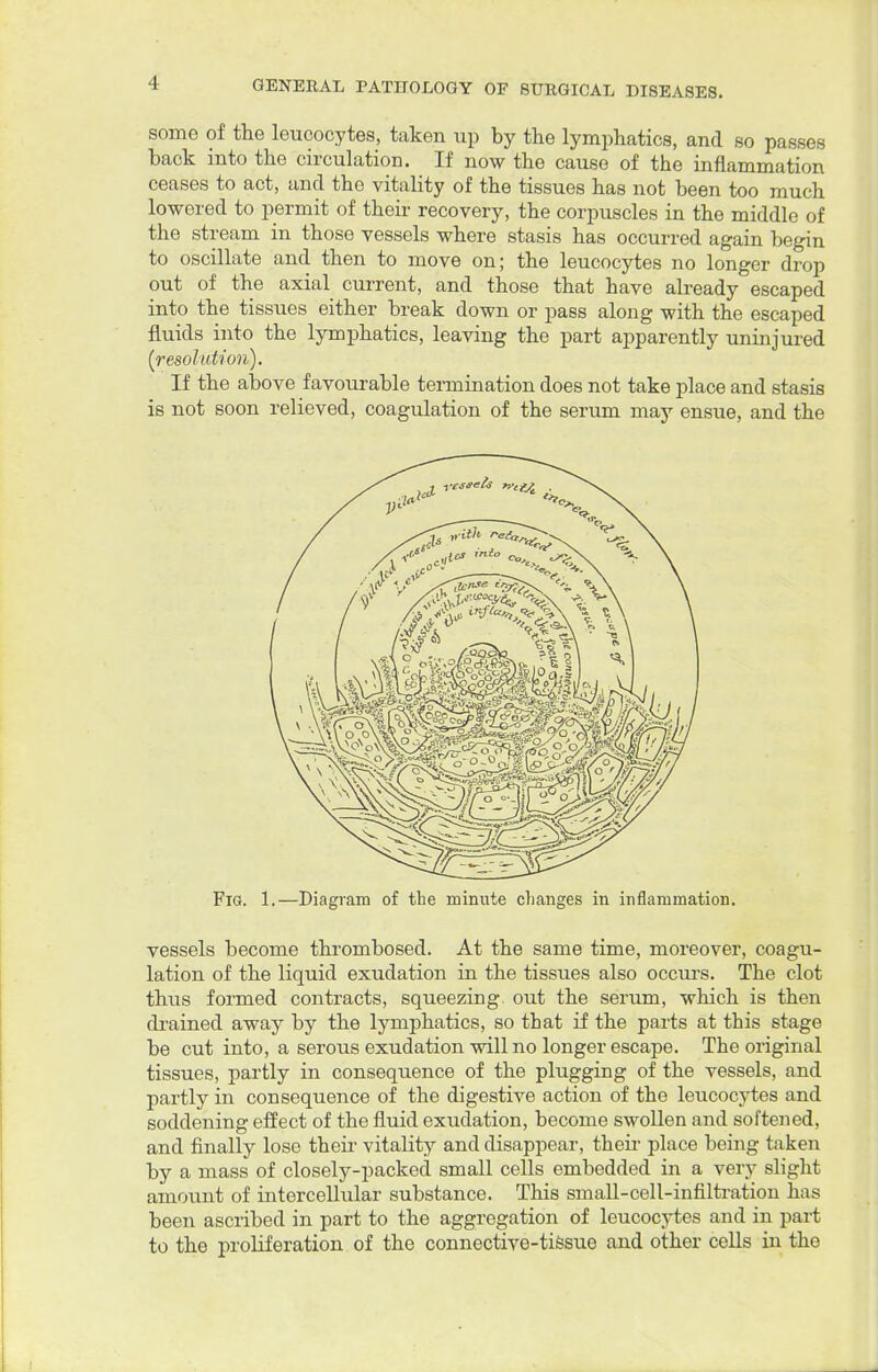 some of the leucocytes, taken up by the lymphatics, and so passes back into the circulation. If now the cause of the inflammation ceases to act, and the vitality of the tissues has not been too much lowered to permit of their recovery, the corpuscles in the middle of the stream in those vessels where stasis has occurred again begin to oscillate and then to move on; the leucocytes no longer drop out of the axial current, and those that have already escaped into the tissues either break down or pass along with the escaped fluids into the lymphatics, leaving the part apparently uninjured (resolution). If the above favourable termination does not take place and stasis is not soon relieved, coagulation of the serum may ensue, and the Fig. 1.—Diagram of the minute changes in inflammation. vessels become thrombosed. At the same time, moreover, coagu- lation of the liquid exudation in the tissues also occurs. The clot thus formed contracts, squeezing out the serum, which is then drained away by the lymphatics, so that if the parts at this stage be cut into, a serous exudation will no longer escape. The original tissues, partly in consequence of the plugging of the vessels, and partly in consequence of the digestive action of the leucocytes and soddening effect of the fluid exudation, become swollen and softened, and finally lose then- vitality and disappear, their place being taken by a mass of closely-packed small cells embedded in a very slight amount of intercellular substance. This small-cell-infiltration has been ascribed in part to the aggregation of leucocytes and in part to the proliferation of the connective-tissue and other cells in the