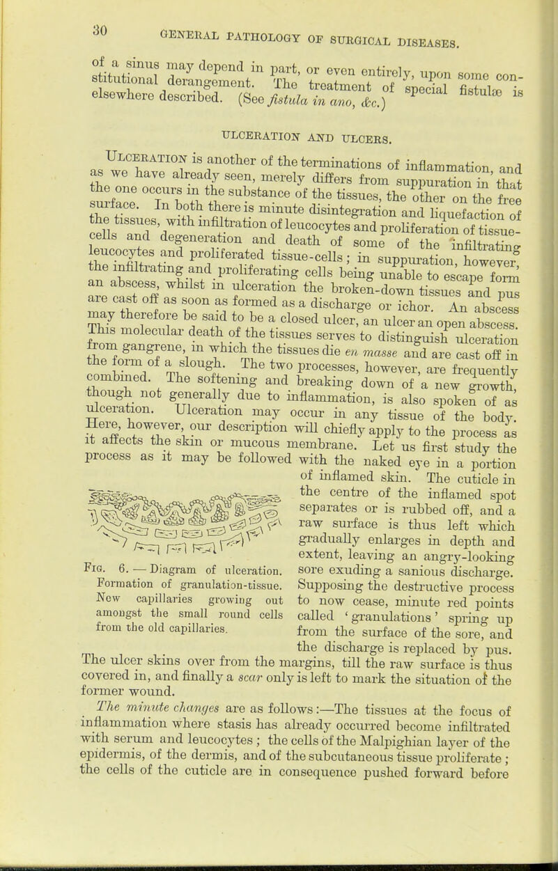 con- i !fay P°nd ln Part' or even entirely. upon some situtional derangement. The treatment of speck &Zte7* elsewhere described. {See fistula in ano, &c.) P * 16 ULCERATION AND ULCERS. Ulceration is another of the terminations of inflammation and as we have already seen, merely differs from snppurS in that urfac: Xbotltt * tissues, the ZJZSe free suilace. In both there is mmute disintegration and liquefaction of ell* HS,rih lnfi/trati°n ?f leuco^S and prditaXSS^ cells and degeneration and death of some of the infiltrating heT.Cfiyife%and Prffei^ed tissue-cells; in suppuration^^6 the infiltrating and proliferating cells being unable to escape fo™ aie cast off as soon as formed as a discharge or ichor. An abscess may therefore be said to be a closed ulcer, an ulcer an open abscess This molecular death of the tissues serves to distinguish iceiTon rom gangrene hi which the tissues die en masse and are cast off in he form of a slough. The two processes, however, are frequently combined The softening and breaking down of a new growth^ though not generally due to inflammation, is also spoken of as ulceration. Ulceration may occur in any tissue of the bodv Here, however our description will chiefly apply to the process as it affects the skin or mucous membrane. Let us first study the process as it may be foUowed with the naked eye in a portion of inflamed skin. The cuticle in jgaggsoc. ^*P*yf*V=35s the Centre of the inflamed spot ?«&OT!¥^Si separates or is rubbed off, and a ^^S^r^SS^^ SUrfaCG iS thuS left Whict i^^k^^^V gradually enlarges in depth and -~\ extent, leaving an angry-looking Fig. 6. — Diagram of ulceration, sore exuding a sanious discharge. Formation of granulation-tissue. Supposing the destructive process New capillaries growing out to now cease, minute red points amougst the small round cells called 'granulations' sprino- up from the old capillaries. from the surface of the sorefand . the discharge is replaced by pus. The ulcer skins over from the margins, till the raw surface is thus covered in, and finally a scar only is left to mark the situation of the former wound. The minute changes are as follows:—The tissues at the focus of inflammation where stasis has already occurred become infiltrated with serum and leucocytes ; the cells of the Malpighian layer of the epidermis, of the dermis, and of the subcutaneous tissue proliferate ; the cells of the cuticle are in consequence pushed forward before