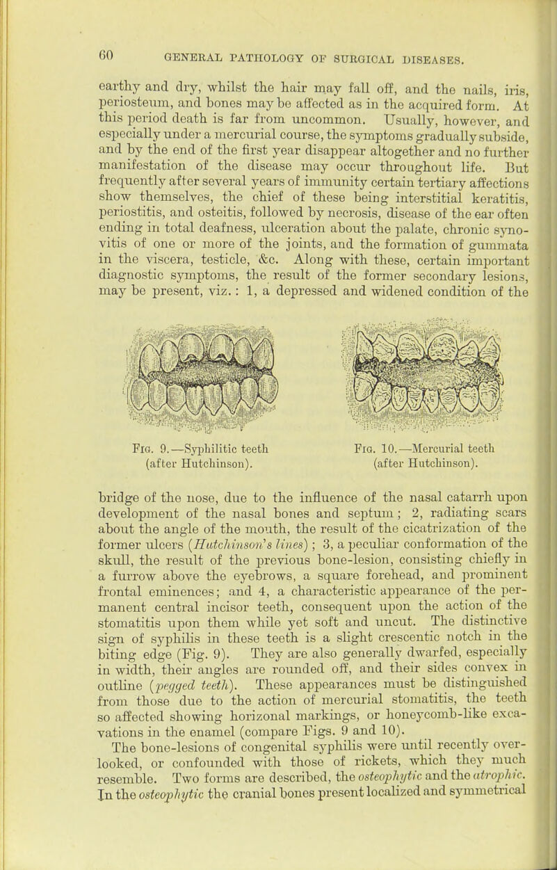 (iO earthy and dry, whilst the hair may fall off, and the nails, iris, periosteum, and hones may be affected as in the acquired form. At this period death is far from uncommon. Usually, however, and especially under a mercurial course, the symptoms gradually subside, and by the end of the first year disappear altogether and no further manifestation of the disease may occur throughout life. But frequently after several years of immunity certain tertiary affections show themselves, the chief of these being interstitial keratitis, periostitis, and osteitis, followed by necrosis, disease of the ear often ending in total deafness, ulceration about the palate, chronic syno- vitis of one or more of the joints, and the formation of gummata in the viscera, testicle, &c. Along with these, certain important diagnostic symptoms, the result of the former secondary lesions, may be present, viz.: 1, a depressed and widened condition of the Fig. 9.—Syphilitic teeth Fig. 10.—Mercurial teeth (after Hutchinson). (after Hutchinson). bridge of the nose, due to the influence of the nasal catarrh upon development of the nasal bones and septum; 2, radiating scars about the angle of the month, the result of the cicatrization of the former ulcers (Hutchinson's lines); 3, a peculiar conformation of the skull, the result of the previous bone-lesion, consisting chiefly in a furrow above the eyebrows, a square forehead, and prominent frontal eminences; and 4, a characteristic appearance of the per- manent central incisor teeth, consequent upon the action of the stomatitis upon them while yet soft and uncut. The distinctive sign of syphilis in these teeth is a slight crescentic notch in the biting edge (Fig. 9). They are also generally dwarfed, especially in width, their angles are rounded off, and their sides convex in outline (pegged teeth). These appearances must be distinguished from those due to the action of mercurial stomatitis, the teeth so affected showing horizonal markings, or honeycomb-like exca- vations in the enamel (compare Figs. 9 and 10). The bone-lesions of congenital syphilis were until recently over- looked, or confounded with those of rickets, which they much resemble. Two forms are described, the osteophyte and the atroph ic. In the osteophyte the cranial bones present localized and symmetrical