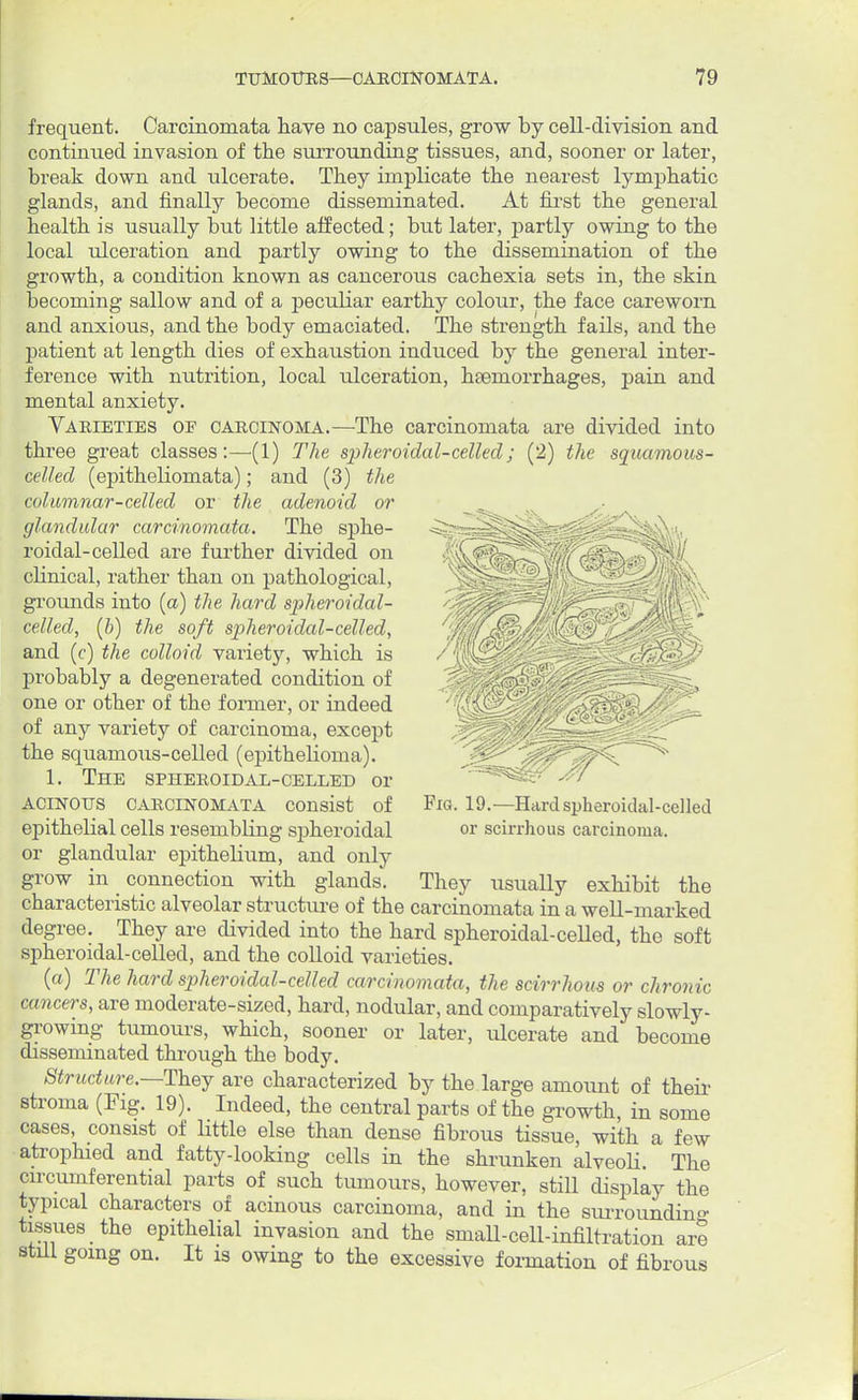 frequent. Carcinomata have no capsules, grow by cell-division and continued invasion of the surrounding tissues, and, sooner or later, break down and ulcerate. They implicate the nearest lymphatic glands, and finally become disseminated. At first the general health is usually but little affected; but later, partly owing to the local ulceration and partly owing to the dissemination of the growth, a condition known as cancerous cachexia sets in, the skin becoming sallow and of a peculiar earthy colour, the face careworn and anxious, and the body emaciated. The strength fails, and the patient at length dies of exhaustion induced by the general inter- ference with nutrition, local ulceration, haemorrhages, pain and mental anxiety. Varieties of carcinoma.—The carcinomata are divided into three great classes:—(1) The spheroidal-celled; (2) the squamous* celled (epitheliomata); and (3) the columnar-celled or the adenoid or glandular carcinomata. The sphe- roidal-celled are further divided on clinical, rather than on pathological, grounds into (a) the hard spheroidal- celled, (b) the soft spheroidal-celled, and (c) the colloid variety, which is probably a degenerated condition of one or other of the fomier, or indeed of any variety of carcinoma, except the squamous-celled (epithelioma). 1. The spheroidal-celled or ACINOUS CARCINOMATA Consist of epithelial cells resembling spheroidal or glandular epithelium, and only grow in connection with glands. characteristic alveolar structure of the carcinomata in a well-marked degree. They are divided into the hard spheroidal-celled, the soft spheroidal-celled, and the colloid varieties. (a) The hard spheroidal-celled carcinomata, the scirrhous or chronic cancers, are moderate-sized, hard, nodular, and comparatively slowly- growing tumours, which, sooner or later, ulcerate and become disseminated through the body. Structure.—They are characterized by the large amount of their stroma (Fig. 19). Indeed, the central parts of the growth, in some cases, consist of little else than dense fibrous tissue, with a few atrophied and fatty-looking cells in the shrunken alveoli. The circumferential parts of such tumours, however, still display the typical characters of acinous carcinoma, and in the surrounding tissues the epithelial invasion and the small-cell-infiltration are still going on. It is owing to the excessive formation of fibrous Fig. 19.—Hard spheroidal-celled or scirrhous carcinoma. They usually exhibit the