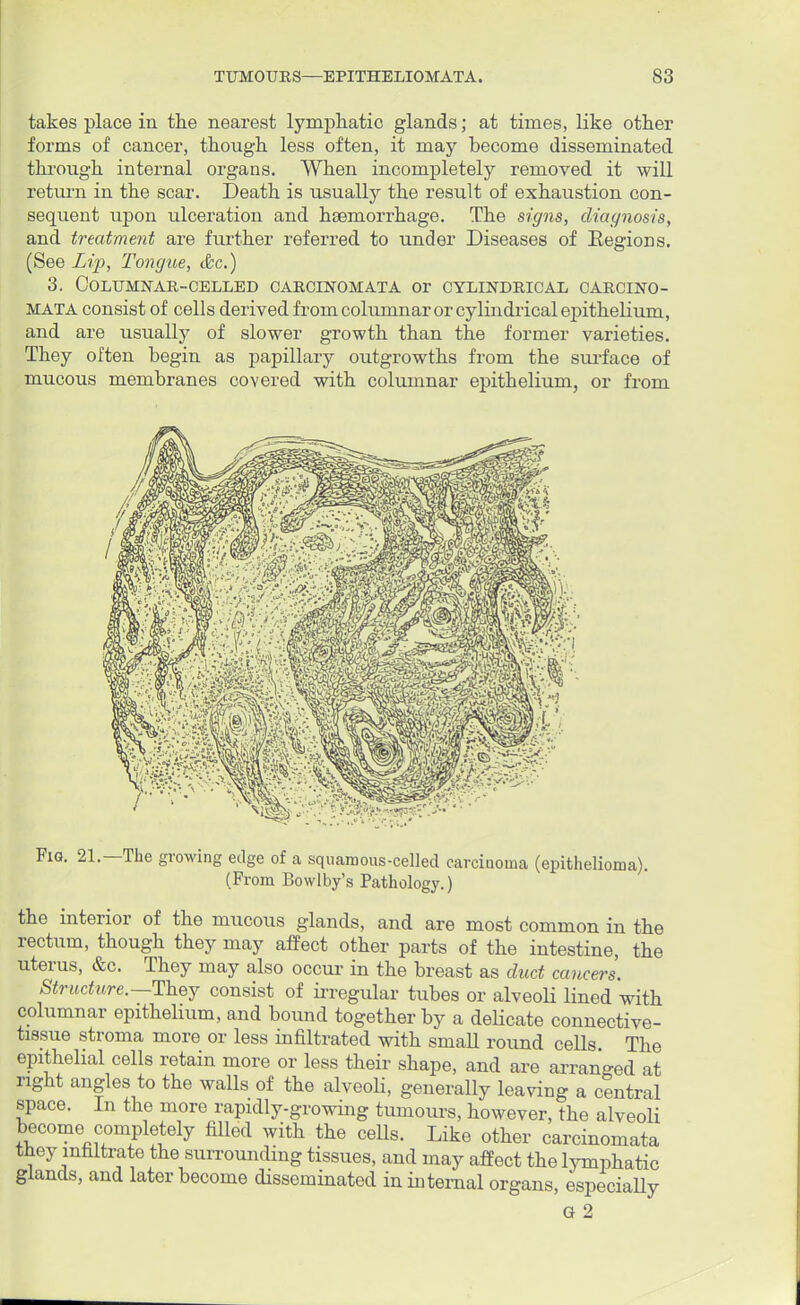 takes place in the nearest lymphatic glands; at times, like other forms of cancer, though less often, it may become disseminated through internal organs. When incompletely removed it will return in the scar. Death is usually the result of exhaustion con- sequent upon ulceration and haemorrhage. The signs, diagnosis, and treatment are further referred to under Diseases of Begions. (See Lip, Tongue, &c.) 3, Columnar-celled carcinomata or cylindrical carcino- mata consist of cells derived from columnar or cylindrical epithelium, and are usually of slower growth than the former varieties. They often begin as papillary outgrowths from the surface of mucous membranes covered with columnar epithelium, or from Fig. 21.—The growing edge of a squamous-celled carcinoma (epithelioma). (Prom Bowlby's Pathology.) the interior of the mucous glands, and are most common in the rectum, though they may affect other parts of the intestine, the uterus, &c. They may also occur in the breast as duct cancers. Structure.—They consist of irregular tubes or alveoli lined with columnar epithelium, and bound together by a delicate connective- tissue stroma more or less infiltrated with small round cells The epithelial cells retain more or less their shape, and are arranged at right angles to the walls of the alveoli, generally leaving a central space. In the more rapidly-growing tumours, however, the alveoli become completely filled with the cells. Like other carcinomata they infiltrate the surrounding tissues, and may affect the lymphatic glands, and later become dissominated in internal organs, especially G 2