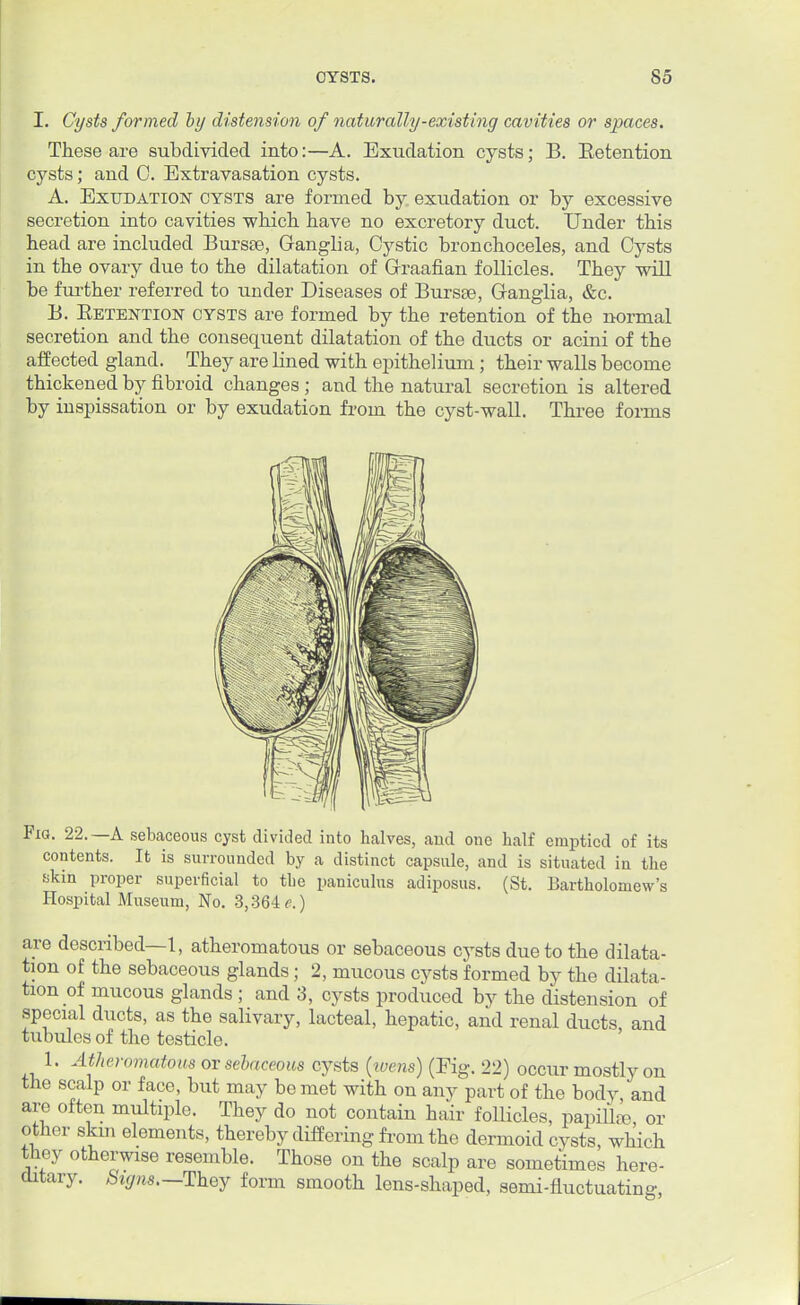 I. Cysts formed by distension of naturally-existing cavities or spaces. These are subdivided into:—A. Exudation cysts; B. Eetention cysts; and 0. Extravasation cysts. A. Exudation cysts are formed by exudation or by excessive secretion into cavities which have no excretory duct. Under this head are included Bursa?, Ganglia, Cystic bronchoceles, and Cysts in the ovary due to the dilatation of Graafian follicles. They will be further referred to under Diseases of Bursse, Ganglia, &c. B. Eetention cysts are formed by the retention of the normal secretion and the consequent dilatation of the ducts or acini of the affected gland. They are lined with epithelium ; their walls become thickened by fibroid changes ; and the natural secretion is altered by inspissation or by exudation from the cyst-wall. Three forms Fig. 22.—A sebaceous cyst divided into halves, and one half emptied of its contents. It is surrounded by a distinct capsule, and is situated in the skin proper superficial to the paniculus adiposus. (St. Bartholomews Hospital Museum, No. 3,364<>.) are described—1, atheromatous or sebaceous cysts due to the dilata- tion of the sebaceous glands; 2, mucous cysts formed by the dilata- tion of mucous glands ; and 3, cysts produced by the distension of special ducts, as the salivary, lacteal, hepatic, and renal ducts, and tubules of the testicle. 1. Atheromatous or sebaceous cysts (wens) (Fig. 22) occur mostly on the scalp or face, but may be met with on any part of the body and are often multiple. They do not contain hair follicles, papilla?, or other skin elements, thereby differing from the dermoid cysts, which they otherwise resemble. Those on the scalp are sometimes here- ditary. %«s._They form smooth lens-shaped, semi-fluctuating,