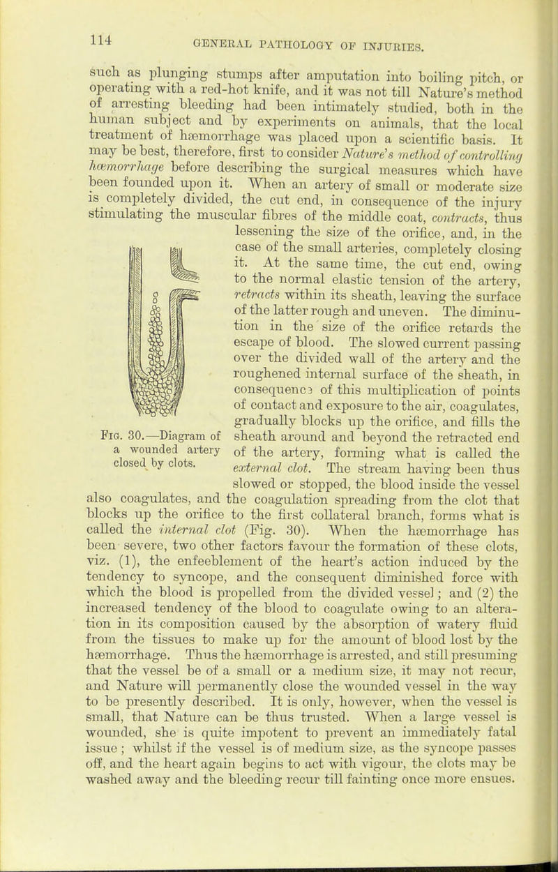 such as plunging stumps after amputation into boiling pitch, or operating with a red-hot knife, and it was not till Nature's method of arresting bleeding had been intimately studied, both in the human subject and by experiments on animals, that the local treatment of haemorrhage was placed upon a scientific basis. It may be best, therefore, first to consider Nature's method of controlling haemorrhage before describing the surgical measures which have been founded upon it. When an artery of small or moderate size is completely divided, the cut end, in consequence of the injury stimulating the muscular fibres of the middle coat, contracts, thus lessening the size of the orifice, and, in the case of the small arteries, completely closing it. At the same time, the cut end, owing to the normal elastic tension of the artery, retracts within its sheath, leaving the surface of the latter rough and uneven. The diminu- tion in the size of the orifice retards the escape of blood. The slowed current passing over the divided wall of the artery and the roughened internal surface of the sheath, in consequenc3 of this multiplication of points of contact and exposure to the air, coagulates, gradually blocks up the orifice, and fills the sheath around and beyond the retracted end of the artery, forming what is called the closed by clots. external clot. The stream having been thus slowed or stopped, the blood inside the vessel also coagulates, and the coagulation spreading from the clot that blocks up the orifice to the first collateral branch, forms what is called the internal clot (Fig. 30). When the haemorrhage has been severe, two other factors favour the formation of these clots, viz. (1), the enfeeblement of the heart's action induced by the tendency to syncope, and the consequent diminished force with which the blood is propelled from the divided vessel; and (2) the increased tendency of the blood to coagulate owing to an altera- tion in its composition caused by the absorption of watery fluid from the tissues to make up for the amount of blood lost by the haemorrhage. Thus the haemorrhage is arrested, and still presuming that the vessel be of a small or a medium size, it may not recur, and Nature will permanently close the wounded vessel in the way to be presently described. It is only, however, when the vessel is small, that Nature can be thus trusted. When a large vessel is wounded, she is quite impotent to prevent an immediately fatal issue ; whilst if the vessel is of medium size, as the syncope passes off, and the heart again begins to act with vigour, the clots may be washed away and the bleeding recur till fainting once more ensues. Fig. 30.—Diagram of wounded artery