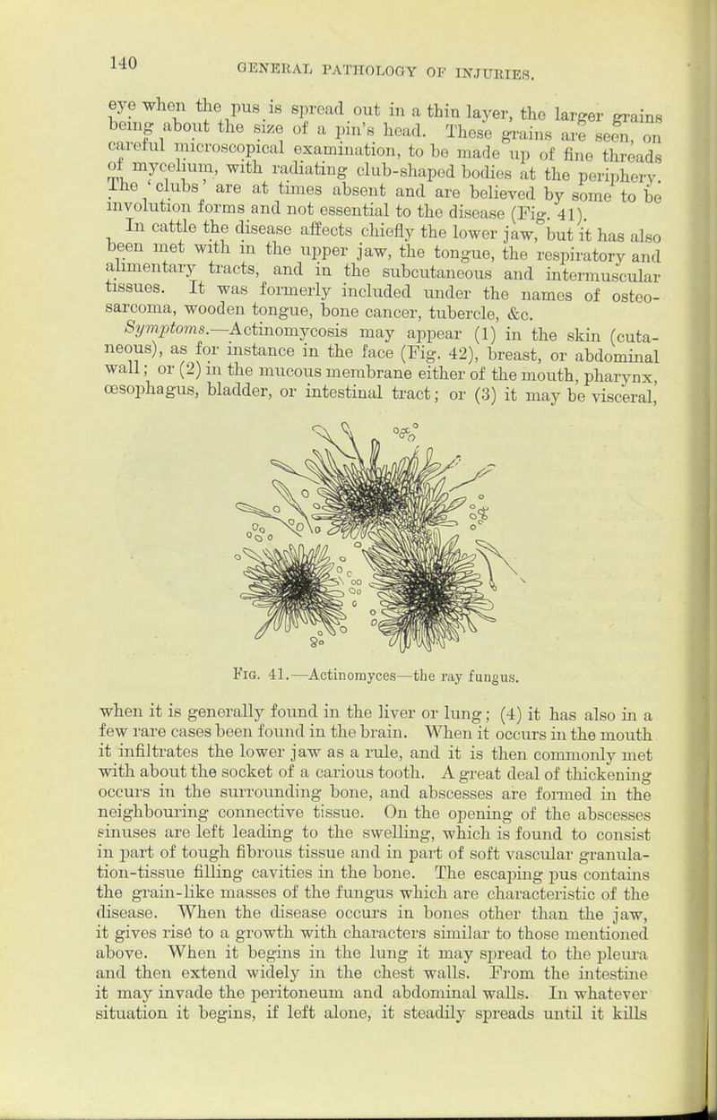 eje when the pus is spread out m a thin layer, the larger grains being about the size of a pin's head. These grains art sefn, on careful microscopical examination, to be made up of fine threads of mycelium, with radiating club-shaped bodies at the periphery Iho clubs are at times absent and are believed by some to be involution forms and not essential to the disease (Fig 41) In cattle the disease affects chiefly the lower jaw, but it has also been met with m the upper jaw, the tongue, the respiratory and alimentary tracts, and in the subcutaneous and intermuscular tissues. It was formerly included under the names of osteo- sarcoma, wooden tongue, bone cancer, tubercle, &c. Symptoms.— Actinomycosis may appear (1) in the skin (cuta- neous), as for instance in the face (Fig. 42), breast, or abdominal wall; or (2) m the mucous membrane either of the mouth, pharynx oesophagus, bladder, or intestinal tract; or (3) it may be visceral' Fig. 41.—Actinomyces—the ray fungus. when it is generally found in the liver or lung; (4) it has also in a few rare cases been found in the brain. When it occurs in the mouth it infiltrates the lower jaw as a rule, and it is then commonly met with about the socket of a carious tooth. A great deal of thickening occurs in the surrounding bone, and abscesses are formed in the neighbouring connective tissue. On the opening of the abscesses sinuses are left leading to the swelling, which is found to consist in part of tough fibrous tissue and in part of soft vascular granula- tion-tissue filling cavities in the bone. The escaping pus contains the grain-like masses of the fungus which are characteristic of the disease. When the disease occurs in bones other than the jaw, it gives rise to a growth with characters similar to those mentioned above. When it begins in the lung it may spread to the pleura and then extend widely in the chest walls. From the intestine it may invade the peritoneum, and abdominal walls. In whatever situation it begins, if left alone, it steadily spreads until it kills