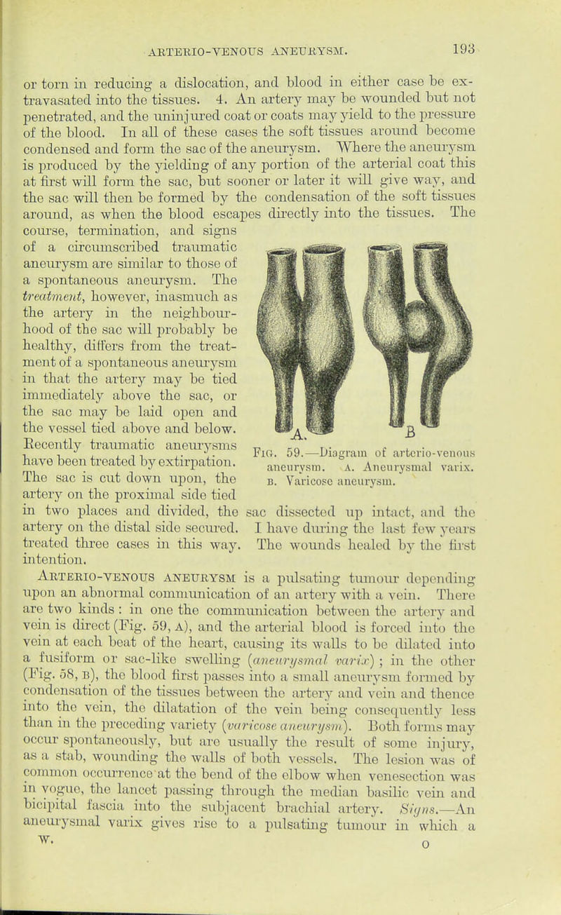 ARTERIOVENOUS ANEURYSM. or torn in reducing a dislocation, and blood in either case be ex- travasated into the tissues. 4. An artery may be wounded but not penetrated, and the uninjured coat or coats may yield to the pressure of the blood. In all of these cases the soft tissues around become condensed and form the sac of the aneurysm. Where the aneurysm is produced by the yielding of any portion of the arterial coat this at first will form the sac, but sooner or later it will give way, and the sac will then be formed by the condensation of the soft tissues around, as when the blood escapes directly into the tissues. The course, termination, and signs of a circumscribed traumatic aneurysm are similar to those of a spontaneous aneurysm. The treatment, however, inasmuch as the artery in the neighbour- hood of tbe sac will probably be healthy, differs from the treat- ment of a spontaneous aneurysm in that the artery may bo tied immediately above the sac, or the sac may be laid open and the vessel tied above and below. Eecently traumatic aneurysms have been treated by extirpation. The sac is cut down upon, the artery on the proximal side tied in two places and divided, the artery on the distal side secured, treated three cases in this way. intention. Arterio-venous aneurysm is a pulsating tumour depending upon an abnormal communication of an artery with a vein. There are two kinds: in one the communication between the artery and vein is direct (Fig. 59, A), and the arterial blood is forced into the vein at each beat of the heart, causing its walls to be dilated into a fusiform or sac-like swelling (aneurysmal varix) ; in the other (Fig. 5<S, b), the blood first passes into a small aneurysm formed by condensation of the tissues between tho artery and vein and thence into the vein, the dilatation of the vein being consequently less than ui the preceding variety (varicose aneurysm). Both form's may occur spontaneously, but are usually the result of some injury, as a stab, wounding the walls of both vessels. The lesion was of common occurrence'at tho bend of the elbow when venesection was hi VOgue, the lancet passing through the median basilic vein and bicipital fascia into the subjacent brachial artery. Signs.—An aneurysmal varix gives rise to a pulsating tumour in which a Fio. 59.—Diagram of artcrio-venous aneurysm. A. Aneurysmal varix. b. Varicose aneurysm. ?ac dissected up intact, and the I have during the last few years The wounds healed by the first w. o