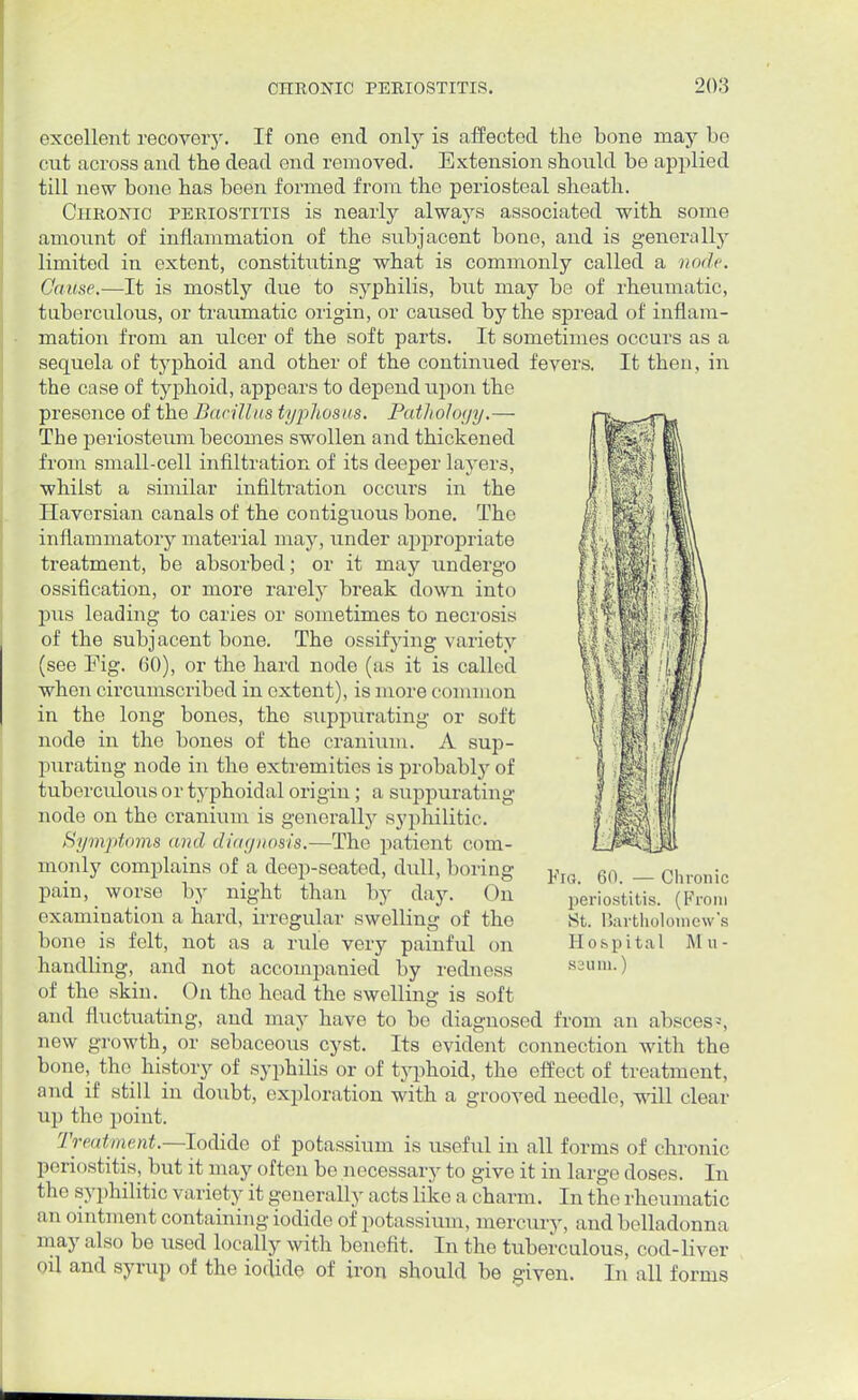 excellent recovery. If one end only is affected the bone may be cut across and tbe dead end removed. Extension should be applied till new bone has been formed from the periosteal sheath. Chronic periostitis is nearly always associated with some amount of inflammation of the subjacent bone, and is generally limited in extent, constituting what is commonly called a node. Cause.—It is mostly due to syphilis, but may be of rheumatic, tuberculous, or traumatic origin, or caused by the spread of inflam- mation from an ulcer of the soft parts. It sometimes occurs as a sequela of typhoid and other of the continued fevers. It then, in the case of typhoid, appears to depend upon the presence of the Bacillus typhosus. Pathology.— The periosteum becomes swollen and thickened from small-cell infiltration of its deeper layers, whilst a similar infiltration occurs in the Haversian canals of the contiguous bone. The inflammatory material may, under appropriate treatment, be absorbed; or it may undergo ossification, or more rarely break down into pus leading to caries or sometimes to necrosis of the subjacent bone. The ossifying variety (see Fig. 60), or the hard node (as it is called when circumscribed in extent), is more common in the long bones, the suppurating or soft node in the bones of the cranium. A sup- purating node in the extremities is probably of tuberculous or typhoidal origin ; a suppurating node on the cranium is generally syphilitic. Symptoms and diagnosis.—The patient com- monly complains of a deep-seated, dull, boring FlG 60 _ chronic pain, worse by night than by day. On periostitis. (From examination a hard, irregular swelling of the St. Bartholomew's bone is felt, not as a rule very painful on Hospital Mil- handling, and not accompanied by redness saum.) of the skin. On the head the swelling is soft and fluctuating, and may have to be diagnosed from an abscess new growth, or sebaceous cyst. Its evident connection with the bone, the history of syphilis or of typhoid, the effect of treatment, and if still in doubt, exploration with a grooved needle, will clear up the point. Treatment.—Iodide of potassium is useful in all forms of chronic 1 >eri< istitis, but it may often be necessary to give it in large doses. In the syphilitic variety it generally acts like a charm. In the rheumatic an ointment containing iodide of potassium, mercury, and belladonna may also be used locally with benefit. In the tuberculous, cod-liver ml and syrup of the iodide of iron should be given. In all forms