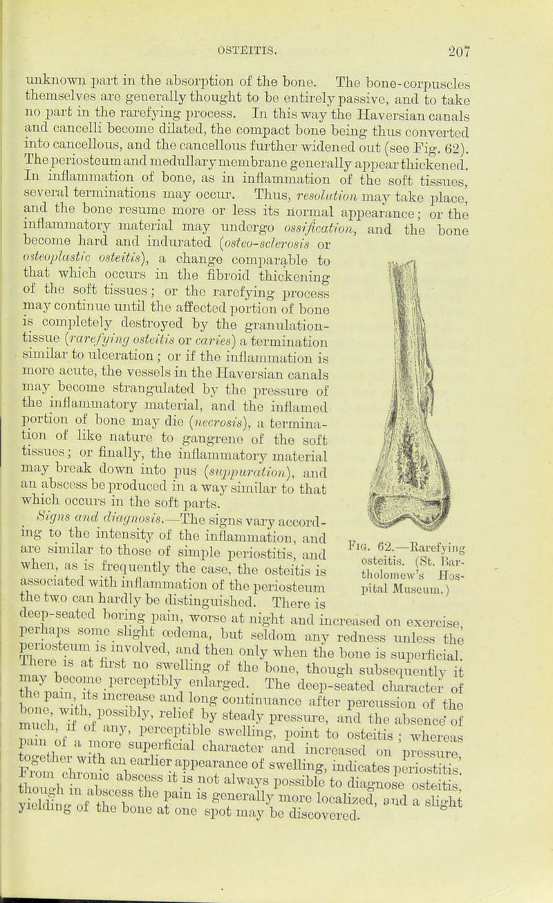 unknown part in the absorption of the bone. The bone-corpuscles themselves are generally thought to be entirely passive, and to take no part in the rarefying process. In this way the Haversian canals and cancelli become dilated, the compact bone being thus converted into cancellous, and the cancellous further widened out (see Fig. 62). The periosteum and medullary membrane generally appear thickened. In inflammation of bone, as in inflammation of the soft tissues, several terminations may occur. Thus, resolution may take place', and the bone resume more or less its normal appearance; or the inflammatory material may undergo ossification, and the bone become hard and indurated (osteosclerosis or osteoplastic osteitis), a change comparable to that which occurs in the fibroid thickening of the soft tissues; or the rarefying process may continue until the affected portion of bone is completely destroyed by the granulation- tissue (rarefying osteitis or caries) a termination similar to ulceration; or if the inflammation is more acute, the vessels in the Haversian canals may become strangulated by the pressure of the inflammatory material, and the inflamed portion of bone may die (necrosis), a termina- tion of like nature to gangrene of the soft tissues; or finally, the inflammatory material may break down into pus (suppuration), and an abscess be produced in a way similar to that which occurs in the soft parts. Signs and diagnosis.—The signs vary am >rd- rng to the intensity of the inflammation, and are similar to those of simple periostitis, and when, as is frequently the case, the osteitis is associated with inflammation of the periosteum the two can hardly be distinguished. There is deep-seated boring pain, worse at night and increased on exercise perhaps someslight oedema, but seldom any redness unless the periosteum is involved, and then only when the bone is superficial. gelling of tie b<™, though subsequently it nay become perceptibly enlarged. The deep-seated character o pain'lts me™ase and long continuance after percussion of the much rf oi any, perceptible swelling, point to osteitis; whereas pun oi a more superficial character and increased on pressure together with an earlier appearance of swelling, indicates PS2 From chronic abscess it is not always possible to SOsteitis' yielding oi the bone at one spot may be discovered. Fig. 62.—Rarefying osteitis. (St. Bar- tholomew's Hos- pital Museum.)