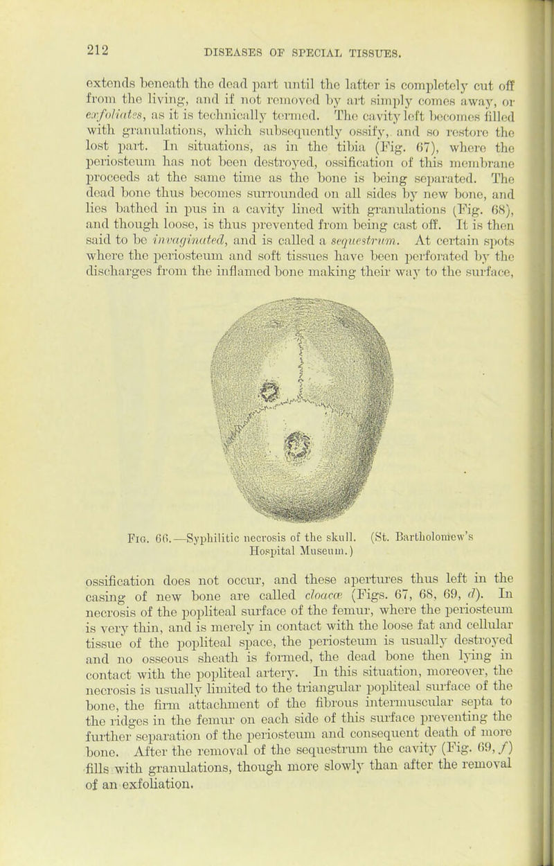 extends beneath the dead part until the latter is completely cul off from the living, and if not removed by art simply comes away, or exfoliates, as it is technically termed. The cavity left becomes filled with granulations, which subsequently ossify, and so restore the lost part. In situations, as in the tibia (Fig. 67), where the periosteum has not been destroyed, ossification of this membrane proceeds at the same time as the hone is being separated. The dead hone thus becomes surrounded on all sides by new hone, and lies bathed in pus in a cavity lined with granulations (Fig. 68), and though loose, is thus prevented from being cast off. It is then said to be invaginated, and is called a sequestrum. At certain spots where the periosteum and soft tissues have been perforated by the discharges from the inflamed bone making their way to the surface, y Fig. 6f>.—Syphilitic necrosis of the skull. (St. Bartholomew's Hospital Museum.) ossification does not occur, and these apertures thus left in the casing of new bone are called cloacae (Figs. 67, 68, 69, d). In necrosis of the popliteal surface of the femur, where the periosteum is very thin, and is merely in contact with the loose fat and cellular tissue of the popliteal space, the periosteum is usually destroyed and no osseous sheath is formed, the dead bone then lying in contact with the popliteal artery. In this situation, moreover, the necrosis is usually limited to the triangular popliteal surface of the bone, the firm attachment of the fibrous intermuscular septa to the ridges in the femur on each side of this surface preventing the further separation of the periosteum and consequent death of more hone. Alter the removal of the sequestrum the cavity (Fig. 69, /) fills with granulations, though more slowly than after the removal of an exfoliation.