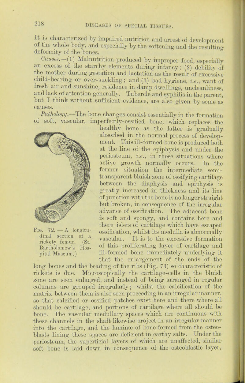 It is characterized by impaired nutrition and arrest of development of the whole body, and especially by the softening and the resulting deformity of the bones. Causes.—(1) Malnutrition produced by improper food, especially an excess of the starchy elements during infancy; (2) debility of the mother during gestation and lactation as the result of excessive child-bearing or over-suckling; and (3) bad hygiene, i.e., want of fresh air and sunshine, residence in damp dwellings, uncleanliness, and lack of attention generally. Tubercle and syphilis in the parent, but I think without sufficient evidence, are also given by some as causes. Patholvyy.—The bone changes consist essentially in the formation of soft, vascular, imperfectly-ossified bone, which replaces the healthy bone as the latter is gradually absorbed in the normal process of develop- ment. This ill-formed bone is produced both at the line of the epiphysis and under the periosteum, i.e., in those situations where active growth normally occurs. In the former situation the intermediate semi- transparent bluish zone of ossifying cartilage between the diaphysis and epiphysis is greatly increased in thickness and its line of junction with the bone is no longer straight but broken, in consequence of the irregular advance of ossification. The adjacent bone is soft and spongy, and contains here and there islets of cartilage which have escaped ossification, whilst its medulla is abnormally vascular. It is to the excessive formation of this proliferating layer of cartilage and ill-formed bone immediately underlying it that the enlargement of the ends of the long bones and the beading of the ribs (Fig. 73) so characteristic of rickets is due. Microscopically the cartilage-cells in the bluish zone are seen enlarged, and instead of being arranged in regular columns are grouped irregularly; whilst the calcification of the matrix between them is also seen proceeding in an irregular manner, so that calcified or ossified patches exist here and there where all should be cartilage, and portions of cartilage where all should be bone. The vascular medullary spaces which arc continuous with these channels in the shaft likewise project in an irregular manner into the cartilage, and the laminae of bone formed from the osteo- blasts lining these spaces are deficient in earthy salts. Under the periosteum, the superficial layers of which are unaffected, similar soft bono is laid down in consequence of the osteoblastic layer, Fig. 72. — A longitu- dinal section of a rickety femur. (St. Bartholomew's Hos- pital Museum.)