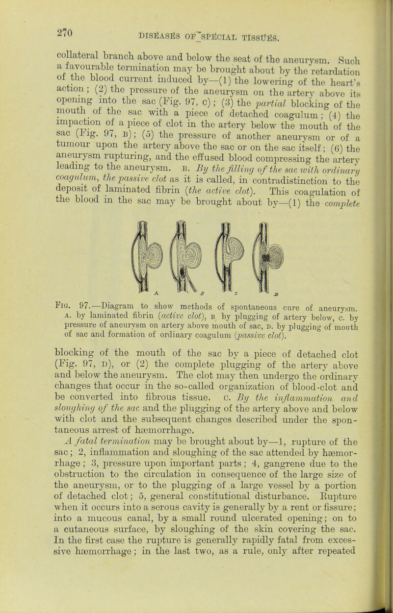 collateral branch above and below the seat of the aneurysm. Such a favourable termination may be brought about by the retardation of the blood current induced by-(l) the lowering of the heart - action ; (2) the pressure of the aneurysm on the artery above its opening into the sac (Fig. 97, c); (3) the partial blocking of the mouth o± the sac with a piece of detached coagulum ; (4) the impaction of a piece of clot in the artery below the mouth of the sac (lug. 97, B); (5) the pressure of another aneurysm or of a tumour upon the artery above the sac or on the sac itself; (G) the aneurysm rupturing, and the effused blood compressing the artery leading to the aneurysm. B. By the filling of the sac with ordinary coagulum, the passive clot as it is called, in contradistinction to the deposit of laminated fibrin {the active clot). This coagulation of the blood m the sac may be brought about bv—(1) the complete Fig. 97.—Diagram to show methods of spontaneous cure of aneurysm. A. by laminated fibrin (active clot), b by plugging of artery below, c. by pressure of aneurysm on artery above mouth of sac, d. by plugging of'mouth of sac and formation of ordinary coagulum (passive clot). blocking of the mouth of the sac by a piece of detached clot (Fig. 97, d), or (2) the complete plugging of the artery above and below the aneurysm. The clot may then undergo the ordinary changes that occur in the so-called organization of blood-clot and be converted into fibrous tissue, c. By the inflammation and sloughing of the sac and the plugging of the artery above and below with clot and the subsequent changes described under the spon- taneous arrest of hemorrhage. A fatal termination may be brought about by—1, rupture of the sac; 2, inflammation and sloughing of the sac attended by haemor- rhage; 3, pressure upon important parts; 4, gangrene due to the obstruction to the circulation in consequence of the large size of the aneurysm, or to the plugging of a large vessel by a portion of detached clot; 5, general constitutional disturbance. Rupture when it occurs into a serous cavity is generally by a rent or fissure; into a mucous canal, by a small round ulcerated opening; on to a cutaneous surface, by sloughing of the skin covering the sac. In the first case the rupture is generally rapidly fatal from exces- sive hemorrhage; in the last two, as a rule, only after repeated