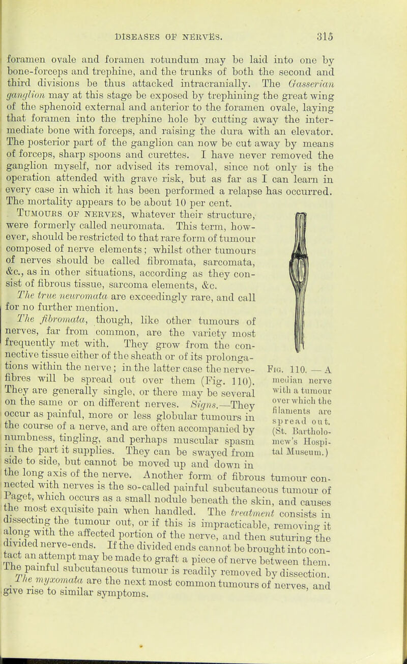 foramen ovale and foramen rotundum may be laid into one by bone-forceps and trephine, and the trunks of both the second and third divisions be thus attacked intracranially. The Gasserian ganglion may at this stage be exposed by trephining the great wing of the sphenoid external and anterior to the foramen ovale, laying that foramen into the trephine hole by cutting away the inter- mediate bone with forceps, and raising the dura with an elevator. The posterior part of the ganglion can now be cut away by means of forceps, sharp spoons and curettes. I have never removed the ganglion myself, nor advised its removal, since not only is the operation attended with grave risk, but as far as I can learn in every case in which it has been performed a relapse has occurred. The mortality appears to be about 10 per cent. Tumours oe nerves, whatever their structure, were formerly called neuromata. This term, how- ever, should be restricted to that rare form of tumour composed of nerve elements; whilst other tumours of nerves should be called fibromata, sarcomata, &c, as in other situations, according as they con- sist of fibrous tissue, sarcoma elements, &c. The true neuromata are exceedingly rare, and call for no further mention. The fibromata, though, like other tumours of nerves, far from common, are the variety most frequently met with. They grow from the con- nective tissue either of the sheath or of its prolonga- tions within the nerve; in the latter case the nerve- fibres will be spread out over them (Fig. I JO). They are generally single, or there may be several on the same or on different nerves. Signs. They occur as painful, more or less globular tumours in the course of a nerve, and are often accompanied by numbness, tingling, and perhaps muscular spasm m the part it supplies. They can be swayed from side to side, but cannot be moved up and down in the long axis of the nerve. Another form of fibrous tumour con- nected with nerves is the so-called painful subcutaneous tumour of Faget, which occurs as a small nodule beneath the skin, and causes the most exquisite pain when handled. The treatment consists in dissecting the tumour out, or if this is impracticable, removing it along with the affected portion of the nerve, and then suturing the divided nerve-ends. If the divided ends cannot be brought into con- tact an attempt may be made to graft a piece of nerve between them, lhe painful subcutaneous tumour is readily removed by dissection. _ 1 he myxomata are the next most common tumours of nerves, and give rise to similar symptoms. Fra 110. — A median nerve with a tumour over which the filaments are spread out. (St, Bartholo- mew's Hospi- tal Museum.)
