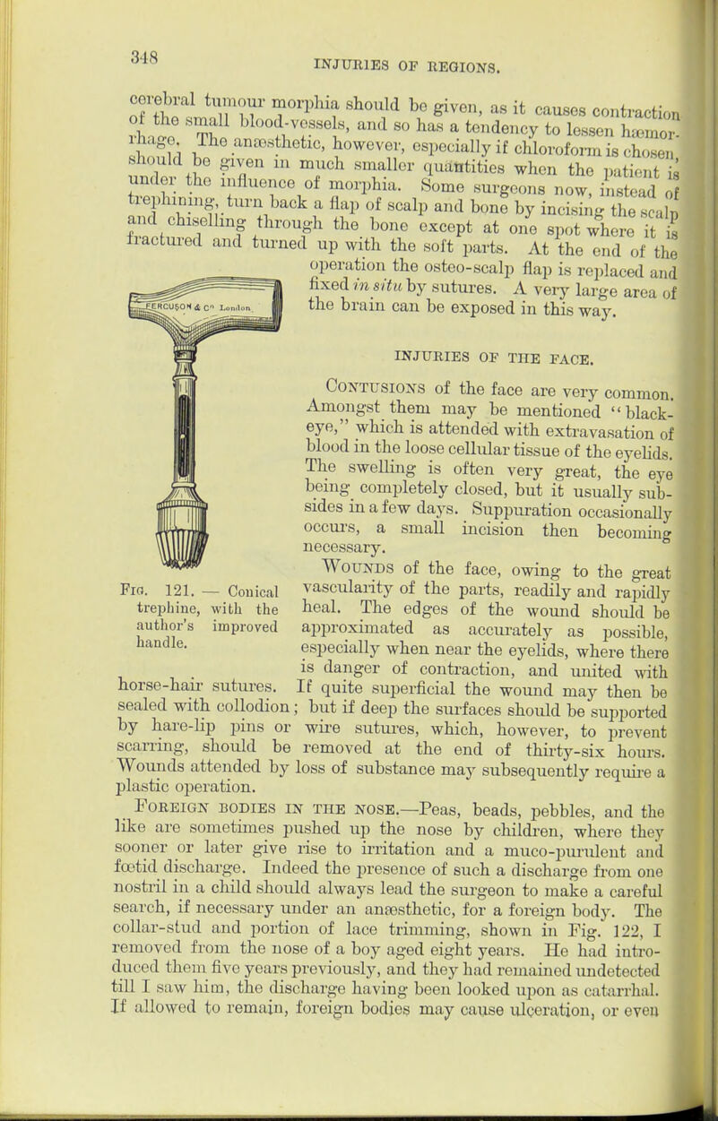 INJURIES OF REGIONS. cerebral tumour morphia should be given, as it causes contracts ft ,Th0 .an^hetxc, however, especially if chloroform is , Wn should be gxyen m much smaller quantities when the patient under the influence of morphia. Some surgeons now, bstead t ^ephanmg turn back a flap of scalp and bont by incishg 1 / , and chiselling through the bone except at one spot where ,1 fractured and turned up with the soft parts. At the end of the operation the osteo-scalp flap is replaced and fixed in situ by sutures. A very large area of the brain can be exposed in this way. INJURIES OF THE FACE. Contusions of the face are very common. Amongst them may be mentioned black- eye, which is attended with extravasation of blood in the loose cellular tissue of the eyelids. The swelling is often very great, the eye being completely closed, but it usually sub- sides in a few days. Suppuration occasionally occurs, a small incision then becomin» necessary. Wounds of the face, owing to the great - Conical vascularity of the parts, readily and rapidly with the heal. The edges of the wound should he improved approximated as accurately as possible, especially when near the eyelids, where there is danger of contraction, and united with horse-haii- sutures. If quite superficial the wound may then be sealed with collodion; but if deep the surfaces should be supported by hare-lip pins or wire sutures, which, however, to prevent scarring, should be removed at the end of thirty-six hours. Wounds attended by loss of substance may subsequently require a plastic operation. Foreign bodies in the nose.—Peas, beads, pebbles, and the like are sometimes pushed up the nose by children, where they sooner or later give rise to irritation and a muco-purulent and foetid discharge. Indeed the presence of such a discharge from one nostril in a child should always lead the surgeon to make a careful search, if necessary under an anaesthetic, for a foreign body. The collar-stud and portion of lace trimming, shown in Fig. 122, I removed from the nose of a boy aged eight years. He had intro- duced them five years previously, and they had remained undetected till I saw him, the discharge having been looked upon as catarrhal. If allowed to remain, foreign bodies may cause ulceration, or even Fio. 121. - trephine, author's handle.