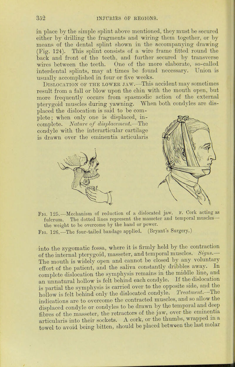 in place by the simple splint above mentioned, they must be secured either by drilling the fragments and wiring them together, or by means of the dental splint shown in the accompanying drawing (Fig. 124). This splint consists of a wire frame fitted round the back and front of the teeth, and further secured by transverse wires between the teeth. One of the more elaborate, so-called interdental splints, may at times be found necessary. Union is usually accomplished in four or five weeks. Dislocation of the lower jaw.—This accident may sometimes result from a fall or blow upon the chin with the mouth open, but more frequently occurs from spasmodic action of the external pterygoid muscles during yawning. When both condyles are dis- placed the dislocation is said to be com- plete; when only one is displaced, in- complete. Nature of displacement.—The condyle with the interarticular cartilage is drawn over the eminentia articularis Fig. 125.—Mechanism of reduction of a dislocated jaw. f. Cork acting as fulcrum. The dotted lines represent the masseter and temporal muscles— the weight to be overcome by the hand or power. Fig. 126.—The four-tailed bandage applied. (Bryant's Surgery.) into the zygomatic fossa, where it is firmly held by the contraction of the internal pterygoid, masseter, and temporal muscles. Signs.— The mouth is widely open and cannot be closed by any voluntary effort of the patient, and the saliva constantly dribbles away. In complete dislocation the symphysis remains in the middle line, and an unnatural hollow is felt behind each condyle. If the dislocation is partial the symphysis is carried over to the opposite side, and the hollow is felt behind only the dislocated condyle. Treatment.— The indications are to overcome the contracted muscles, and so allow the displaced condyle or condyles to be drawn by the temporal and deep fibres of the masseter, the retractors of the jaw, over the eminentia articularis into their sockets. A cork, or the thumbs, wrapped m a towel to avoid being bitten, should be placed between the last molar