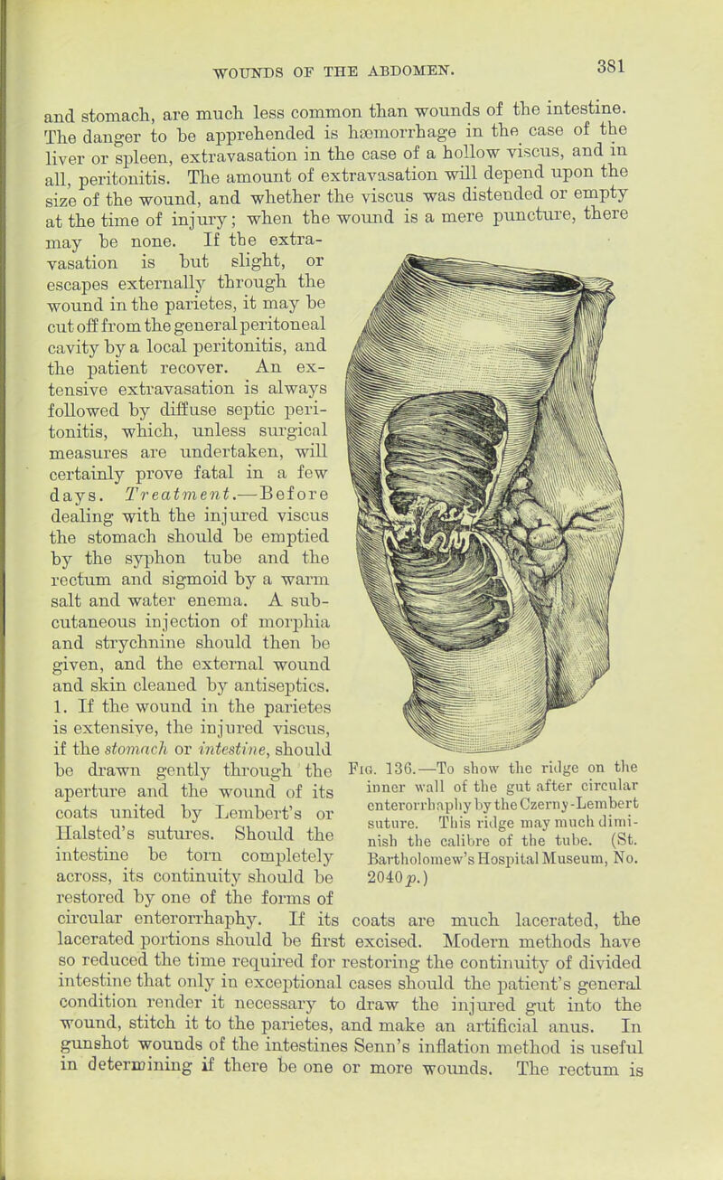 and stomach, are much less common than wounds of the intestine. The danger to be apprehended is haemorrhage in the case of the liver or spleen, extravasation in the case of a hollow viscus, and m all, peritonitis. The amount of extravasation will depend upon the size of the wound, and whether the viscus was distended or empty at the time of injury; when the wound is a mere puncture, there may he none. If the extra- vasation is but slight, or escapes externally through the wound in the parietes, it may be cut off from the general peritoneal cavity by a local peritonitis, and the patient recover. An ex- tensive extravasation is always followed by diffuse septic peri- tonitis, which, unless surgical measures are undertaken, will certainly prove fatal in a few days. Treatment.—Before dealing with the injured viscus the stomach should be emptied by the syphon tube and the rectum and sigmoid by a warm salt and water enema. A sub- cutaneous injection of morphia and strychnine should then be given, and the external wound and skin cleaned by antiseptics. 1. If the wound in the parietes is extensive, the injured viscus, if the stomach or intestine, should be drawn gently through the aperture and the wound of its coats united by Lembert's or Halsted's sutures. Should the intestine be torn completely across, its continuity should be restored by one of the forms of circular enterorrhaphy. If its coats are much lacerated, the lacerated portions should be first excised. Modern methods have so reduced the time required for restoring the continuity of divided intestine that only in exceptional cases should the patient's general condition render it necessary to draw the injured gut into the wound, stitch it to the parietes, and make an artificial anus. In gunshot wounds of the intestines Senn's inflation method is useful in determining if there be one or more wounds. The rectum is Fig. 136.—To show the ridge on the inner wall of the gut after circular enterorrhaphy by theCzerny-Lembert suture. This ridge may much dimi- nish the calibre of the tube. (St. Bartholomew's Hospital Museum, No. 2040p.)