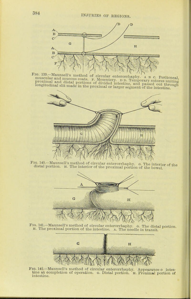 INJURIES OF REGIONS. F™^n85S method of circular enterorrhaphy. a u c Peritc longitudinal slit made in the proximal or larger segment of the intestine Fig. 140.—Maunsell's method of circular enterorrhaphy. g. The interior of tho distal portion, h. The interior of the proximal portion of the bowel Fig. 141.—Maunsell's method of circular enterorrhaphy. g. The distal portion H. The proximal portion of the intestine, a. The needle in transit. Fig. 142.—Maunsell's method of circular enterorrhaphy. Appearauce o intes- tine at completion of operation, g. Distal portion. H. Proximal portion of intestine.