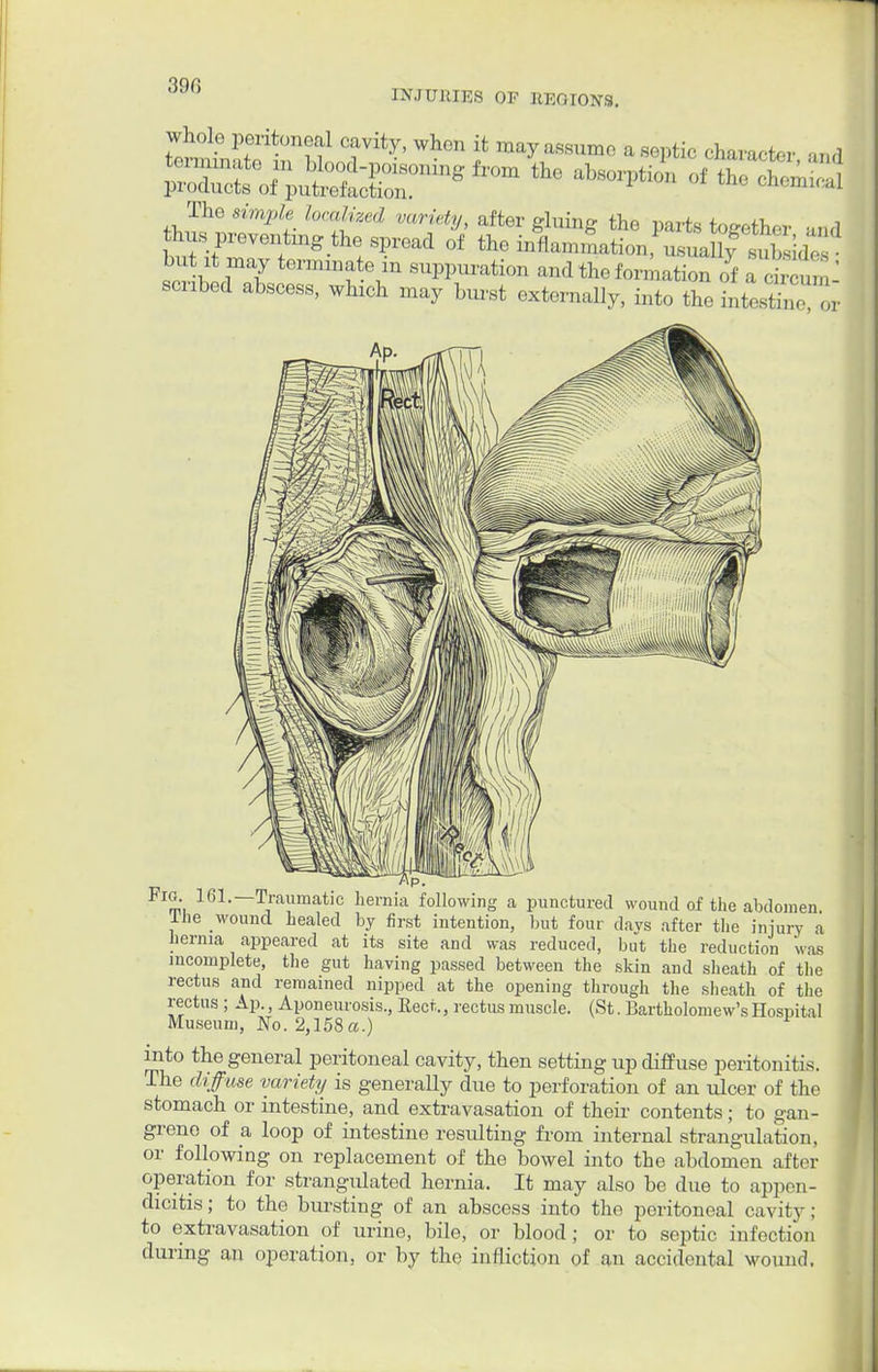 390 INJURIES OF REGIONS. whole peritoneal cavity, when it may assume a sentic dm****, i Fig 161.—Traumatic hernia following a punctured wound of the abdomen Ihe wound healed by first intention, but four days after the injury a hernia appeared at its site and was reduced, but the reduction was incomplete, the gut having passed between the skin and sheath of the rectus and remained nipped at the opening through the sheath of the rectus ; Ap., Aponeurosis., Rect,, rectus muscle. (St. Bartholomew's Hospital Museum, No. 2,158 a.) y into the general peritoneal cavity, then setting up diffuse peritonitis. The diffuse variety is generally due to perforation of an ulcer of the stomach or intestine, and extravasation of their contents; to gan- grene of a loop of intestine resulting from internal strangulation, or following on replacement of the bowel into the abdomen after operation for strangulated hernia. It may also be due to appen- dicitis; to the bursting of an abscess into the peritoneal cavity; to extravasation of urine, bile, or blood; or to septic infection during an operation, or by the infliction of an accidental wound.