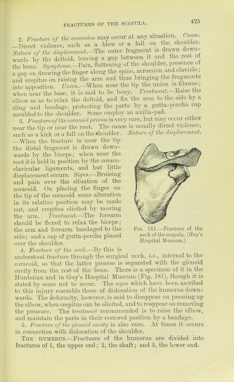 FRACTURES OF THE SCAPULA. 2 Fracture of the acromion may occur at any situation Cause. -Direct violence, such as a blow or a fall on the shoulder. Nature of the displacement.-The outer fragment is drawn down- wards by the deltoid, leaving a gap between it and the lest ot the bone! Symptoms.-P*m, flattening of the shoulder, presence of a gap on drawing the finger along the spine acromion and clavicle ; and crepitus on raising the arm and thus bringing the fragments into apposition. Union.-When near the tip the union is fibrous; when near the base, it is said to be bony. Treatment -Kaisc> the elbow so as to relax the deltoid, and fix the arm to the side by a sling and bandage, protecting the parts by a gutta-percha cap moulded to the shordder. Homo employ an axil la-pad. 3. Fracture of the coracoid process is very rare, but may occur either near the tip or'near the root. The cause is usually direct violence, such as a kick or a fall on the shoulder. Nature of the displacement. —When the fractiu'c is near the tip the distal fragment is drawn down- wards by the biceps; when near the root it is held in position by the coraco- clavicular ligaments, and but little displacement occurs. Signs.—Bruising and pain over the situation of the coracoid. On placing the finger on the tip of the coracoid some alteration in its relative position may be made out, and crepitus elicited by moving the arm. Treatment.—The forearm should be flexed to relax the biceps; the arm and forearm bandaged to the side; and a cap of gutta-percha placed over the shoulder. 4. Fracture of the neck.—By this is understood fracture through the surgical neck, i.e., internal to the coracoid, so that the latter process is separated with the glenoid cavity from the rest of the bone. There is a specimen of it in the Hunterian and in Guy's Hospital Museum (Fig. 181), though it is stated by some not to occur. The signs which have been ascribed to this injury resemble those of dislocation of the humerus down- wards. The deformity, however, is said to disappear on pressingup the elbow, when crepitus can be elicited, and to reappear on removing the pressure. The treatment recommended is to raise the elbow, and maintain the parts in their restored position by a bandage. 5. Fracture of the glenoid cavity is also rare. At times it occurs in connection with dislocation of the shoulder. The humerus.—Fractures of the humerus are divided into fractures of 1, the upper end; 2, the shaft; and 3, the lower end. Fig. 181.—Fracture of the neck of the scapula. (Guy's Hospital Museum.)
