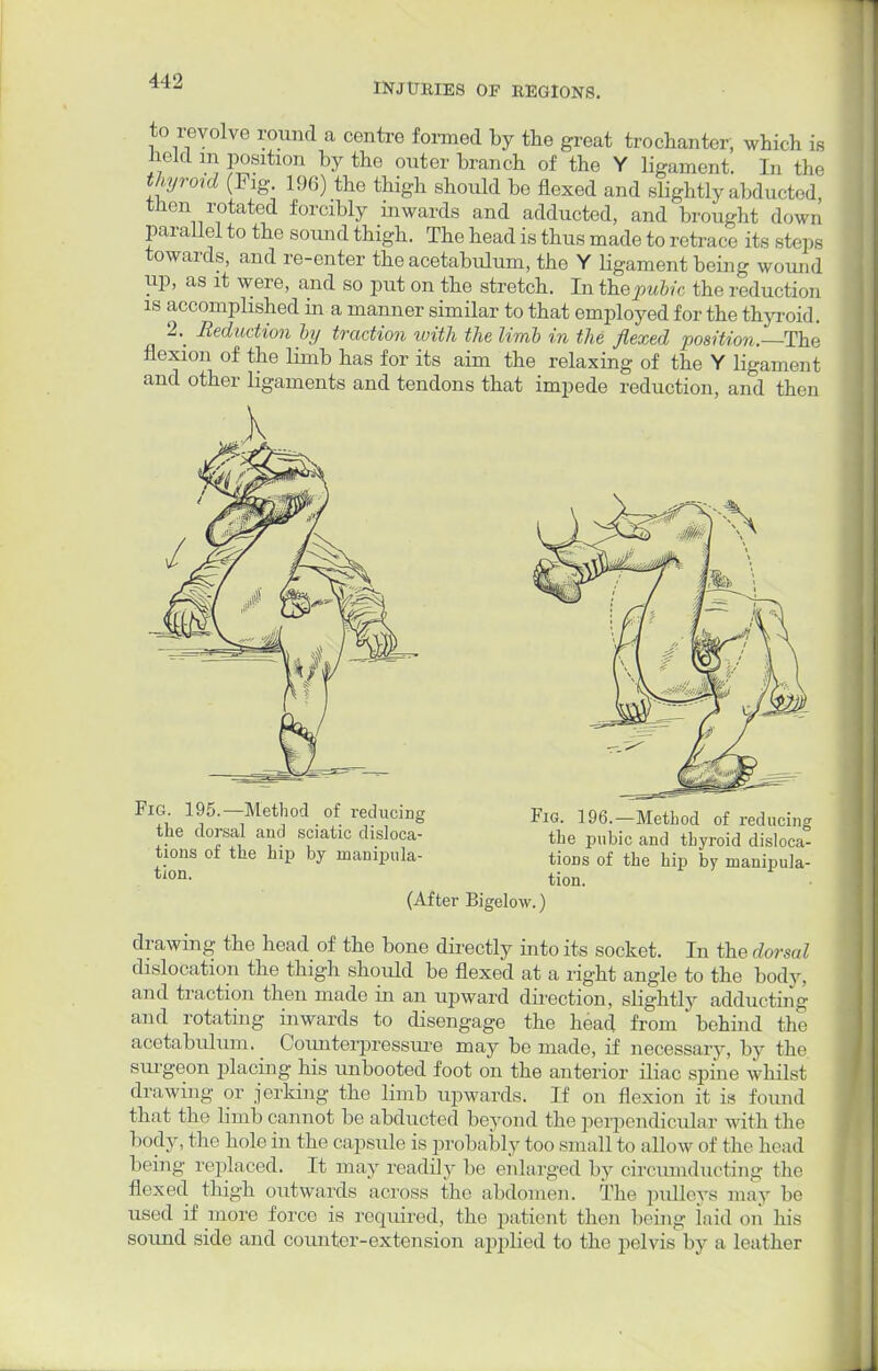 INJURIES OF REGIONS. to revolve round a centre framed by the great trochanter, which is held m position by the outer branch of the Y ligament. In the thyroid (Fig. 196) the thigh should be flexed and slightly abducted then rotated forcibly inwards and adducted, and brought down Parallel to the sound thigh. The head is thus made to retrace its steps towards, and re-enter the acetabulum, the Y ligament being wound up, as it were, and so put on the stretch. In the pubic the reduction is accomplished in a manner similar to that employed for the thyroid. 2. Reduction by traction with the limb in the flexed position.—The flexion of the limb has for its aim the relaxing of the Y ligament and other ligaments and tendons that impede reduction, and then Fig. 195.—Method of reducing the dorsal and sciatic disloca- tions of the hip by manipula- tion. Fig. 196.—Method of reducing the pubic and thyroid disloca- tions of the hip by manipula- tion. (After Bigelow.) drawing the head of the bone directly into its socket. In the dorsal dislocation the thigh should be flexed at a right angle to the body, and traction then made in an upward direction, slightly adducting and rotating inwards to disengage the head from behind the acetabulum. Counterpressure may be made, if necessary, by the surgeon placing his unbooted foot on the anterior iliac spine whilst drawing or jerking the limb upwards. If on flexion it is found that tho limb cannot be abducted beyond the perpendicular with the 1 »< >dy, the hole in the capsule is probably too small t«» all. iw of the In iad being replaced. It may readily be enlarged by circumducting the flexed thigh outwards a.moss the abdomen. The pulleys may be used if more force is required, the patient then being laid mi his sound side and counter-extension applied to the pelvis by a leather