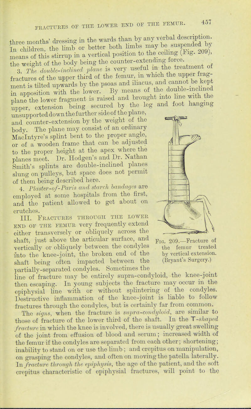 three months' dressing in the wards than by any verbal description. In » the limb or better both limbs may befended by means of this stirrup in a vertical position to the ceding (Fig. 209), the weight of the body being the counter-extending force. irThe douUe-inclied plane is very useful m the treatment of fractures of the upper third of the femur, m which the upper frag- ments tilted upwards by the psoas and iliacus, and cannot be kept S apposition with the lower. By means of he ^le-m^ plane the lower fragment is raised and brought into line with the upper, extension being secured by the leg and foot hanging unsupported down thefurther sideof the plane, and counter-extension by the weight of the body. The plane may consist of an ordinary Maclntyre's splint bent to the proper angle, or of a wooden frame that can be adjusted to the proper height at the apex where the planes meet. Dr. Hodgen's and Dr. Nathan Smith's splints are double-inclined planes slung on pulleys, but space does not permit of them being described here. 4. PI aster-of-Par is and starch bandages are employed at some hospitals from the first, and the patient allowed to get about on crutches. III. Fractures through the lower end of the femur very frequently extend either transversely or obliquely across the shaft, just above the articular surface, and vertically or obliquely between the condyles into the knee-joint, the broken end of the shaft being often impacted between the partially-separated condyles. Sometimes the line of fracture may be entirely supra-condyloid, the knee-joint then escaping. In young subjects the fracture may occur in the epiphysial line with or without splintering of the condyles. Destructive inflammation of the knee-joint is liable to follow fractures through the condyles, but is certainly far from common. The signs, when the fracture is supra-condyloid, are similar to those of fracture of the lower third of the shaft. In the T-shaped fracture in which the knee is involved, there is usually great swelling of the joint from effusion of blood and serum ; increased width of the femur if the condyles are separated from each other; shortening; inability to stand on or use the limb ; and crepitus on manipulation, on grasping the condyles, and often on moving the patella laterally. In. fracture through the epiphysis, the age of the patient, and the soft crepitus characteristic of epiphysial fractures, will point to the Fig. 209.—Fracture of the femur treated by vertical extension. (Bryant's Surgery.)